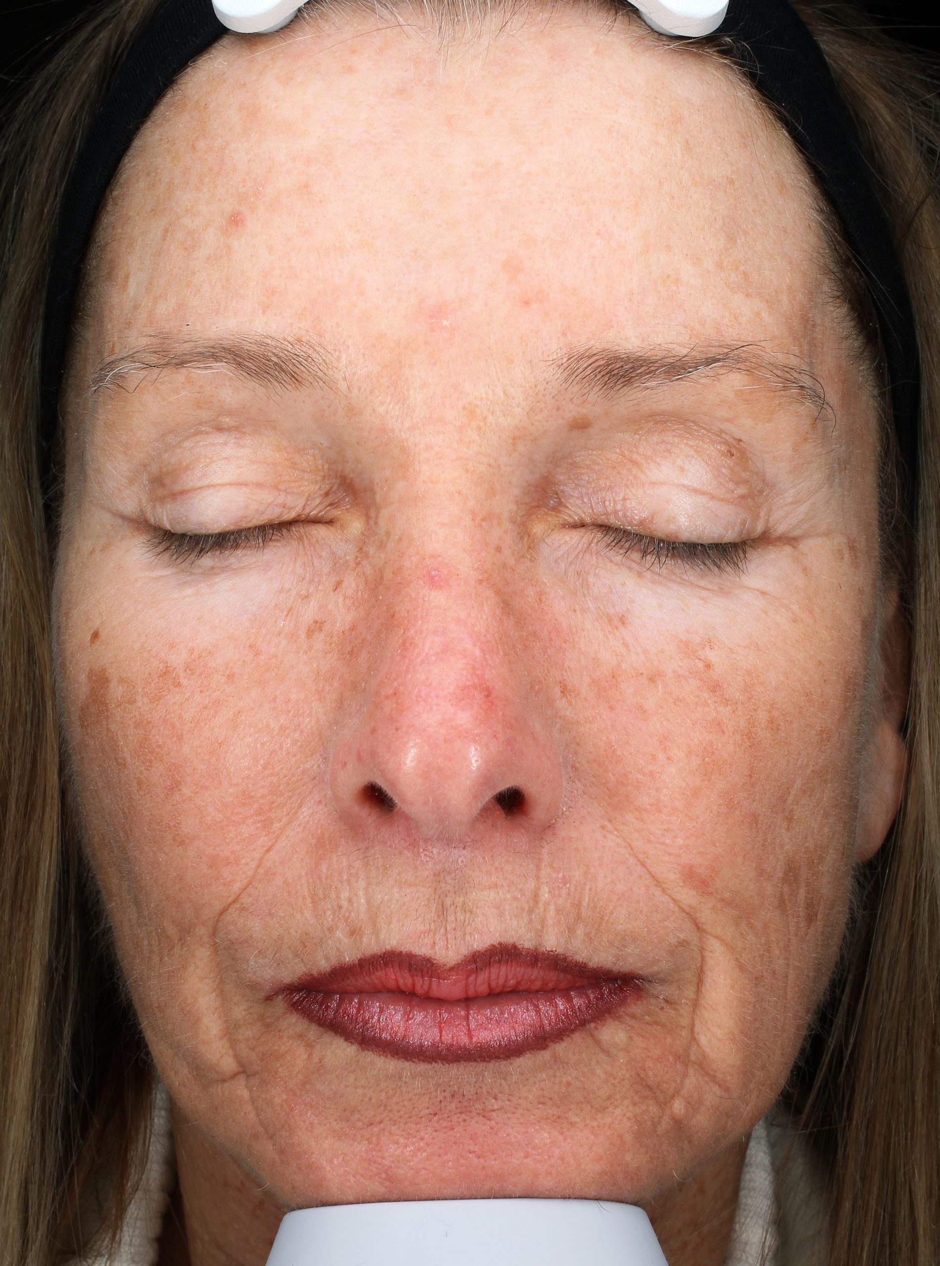 Patient 26 Before Image