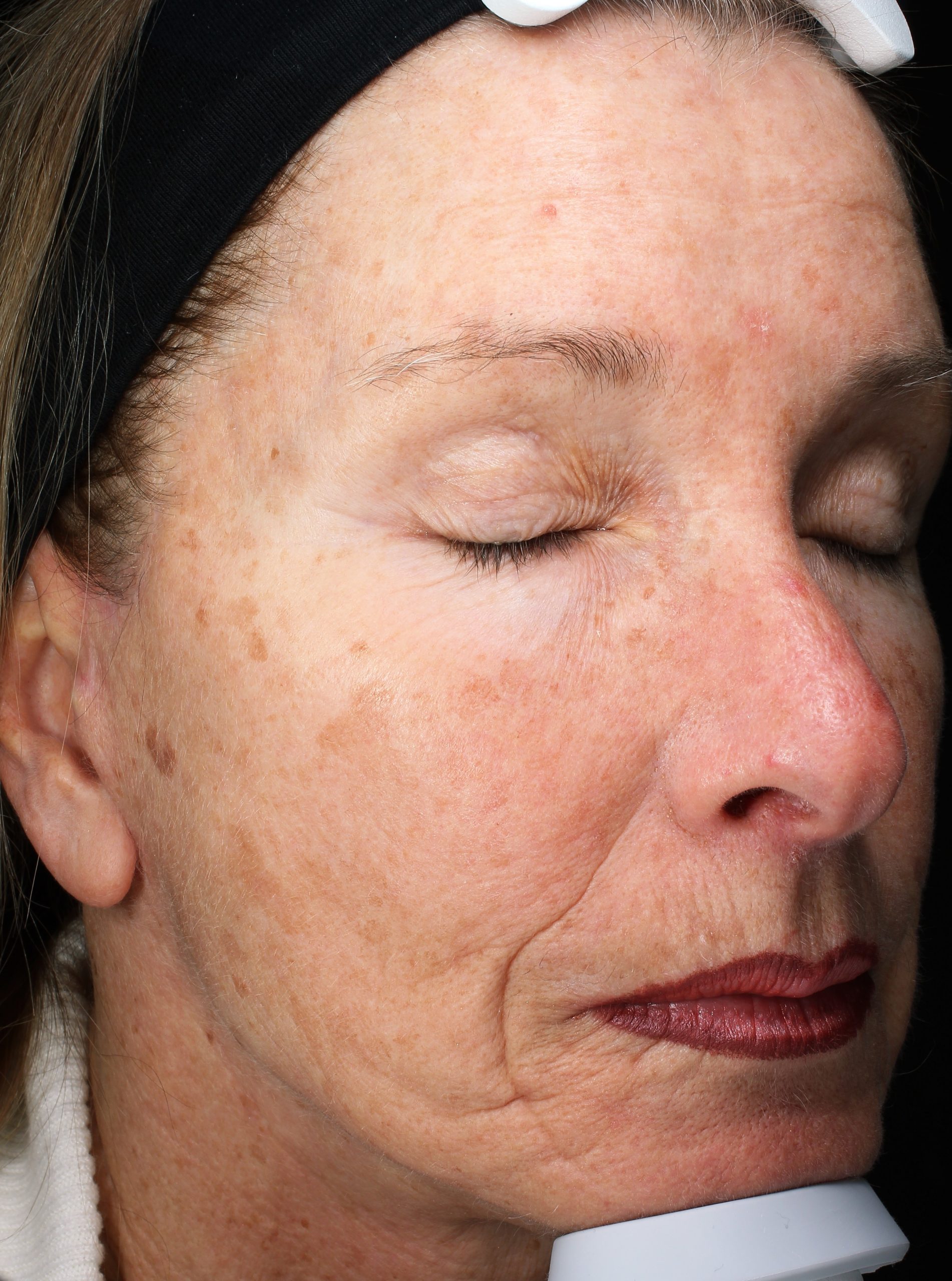 Patient 26 Before Image