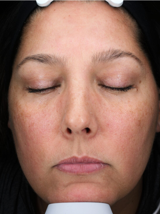 Patient 29 Before Image