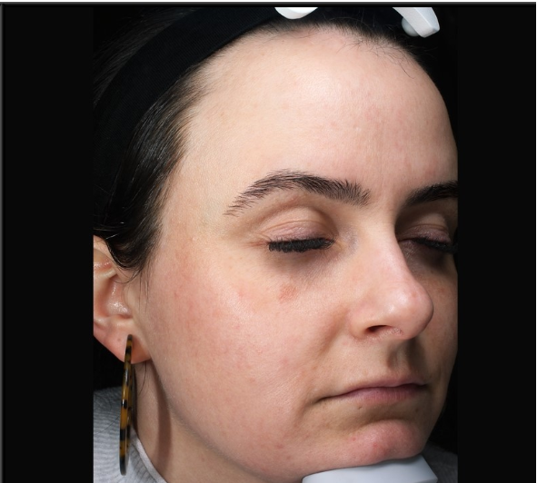 Patient 28 After Image