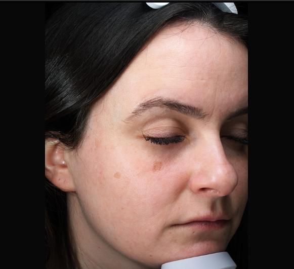 Patient 28 Before Image