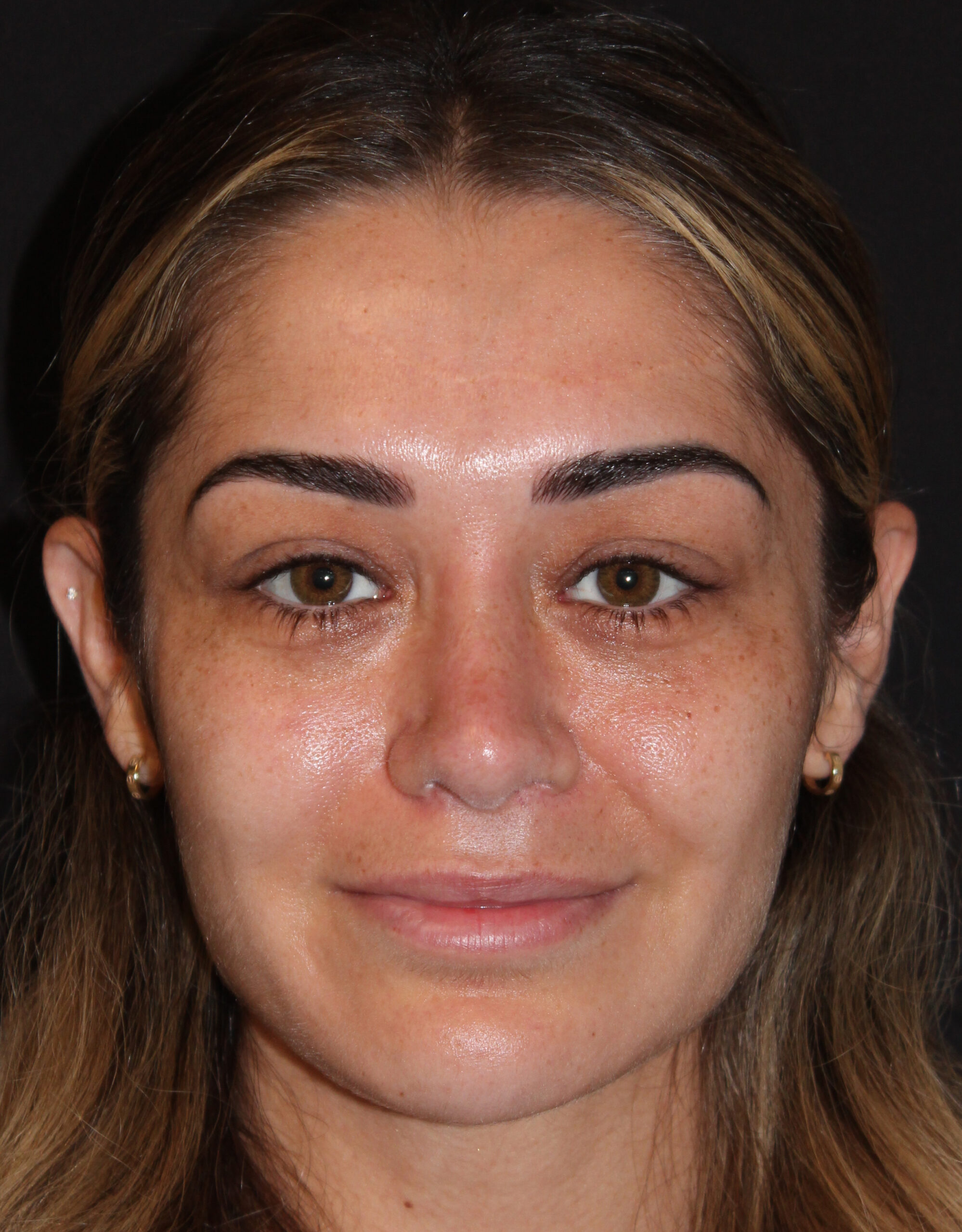 Patient #179 After Image