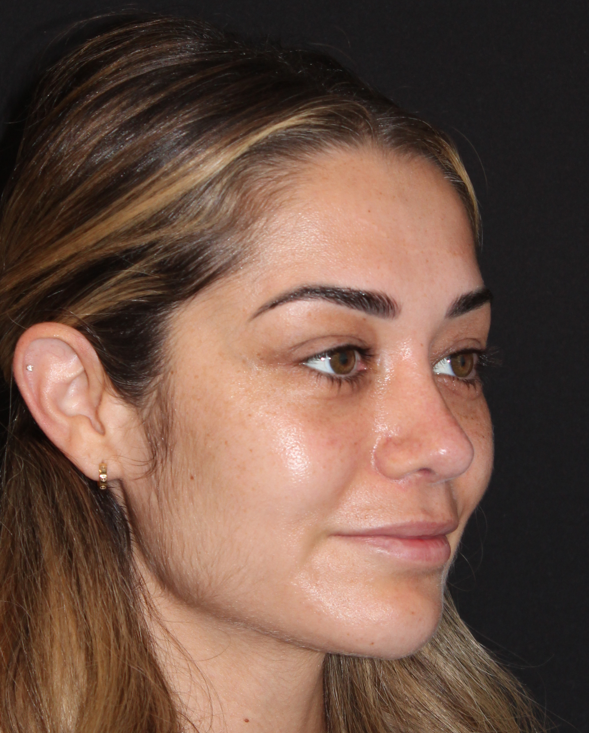 Patient #179 After Image