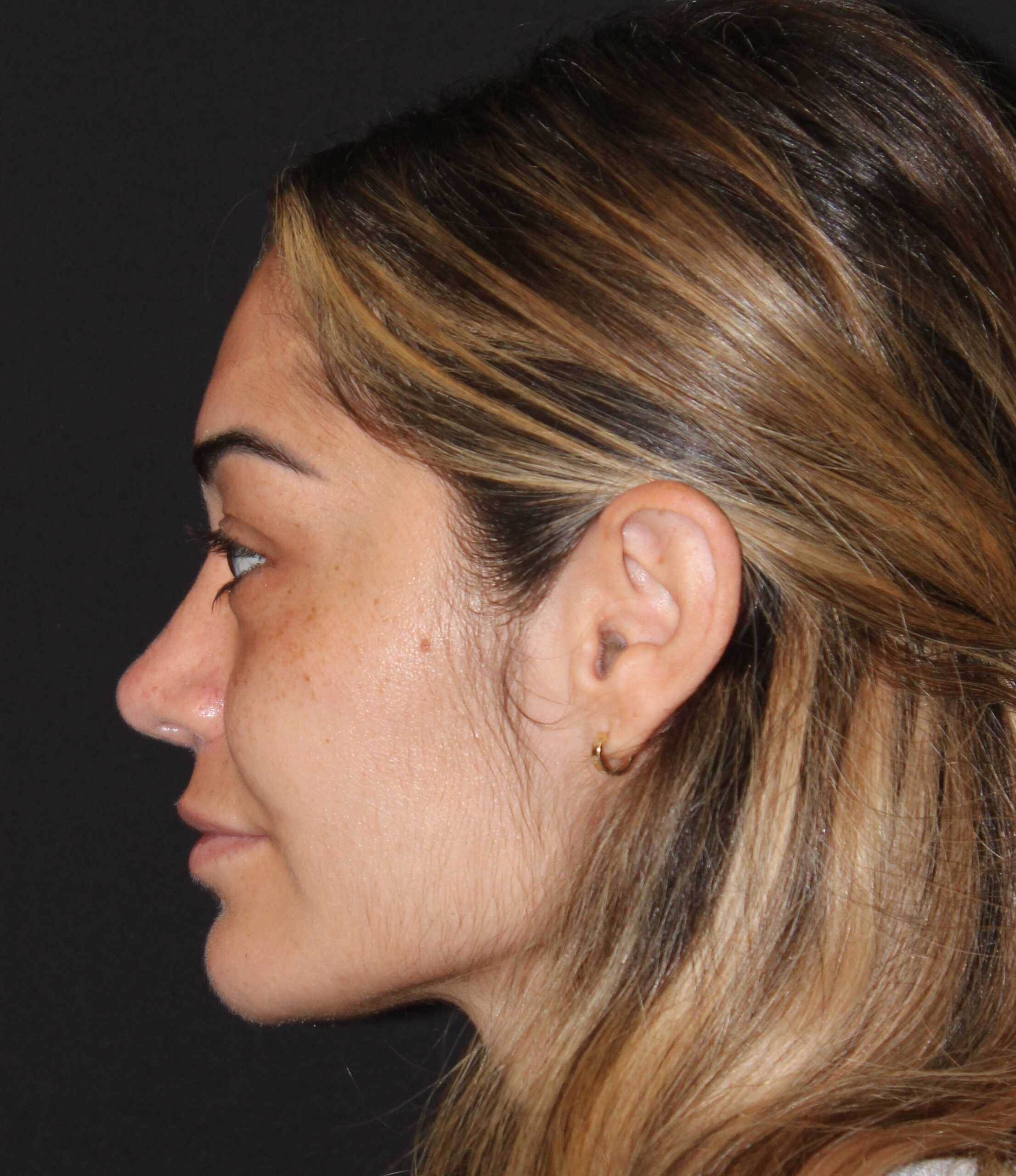 Patient #179 After Image