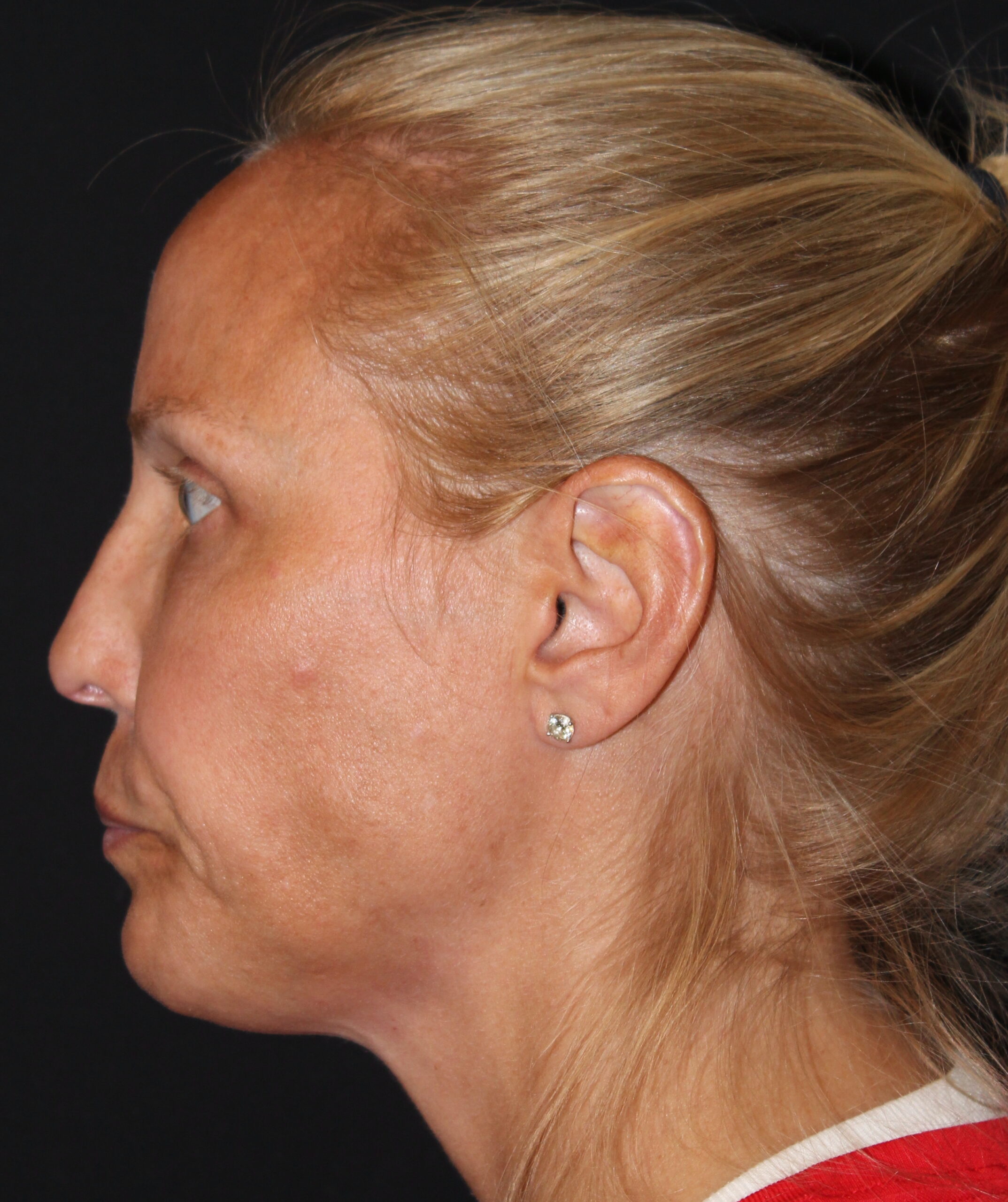 Patient 103 Before Image
