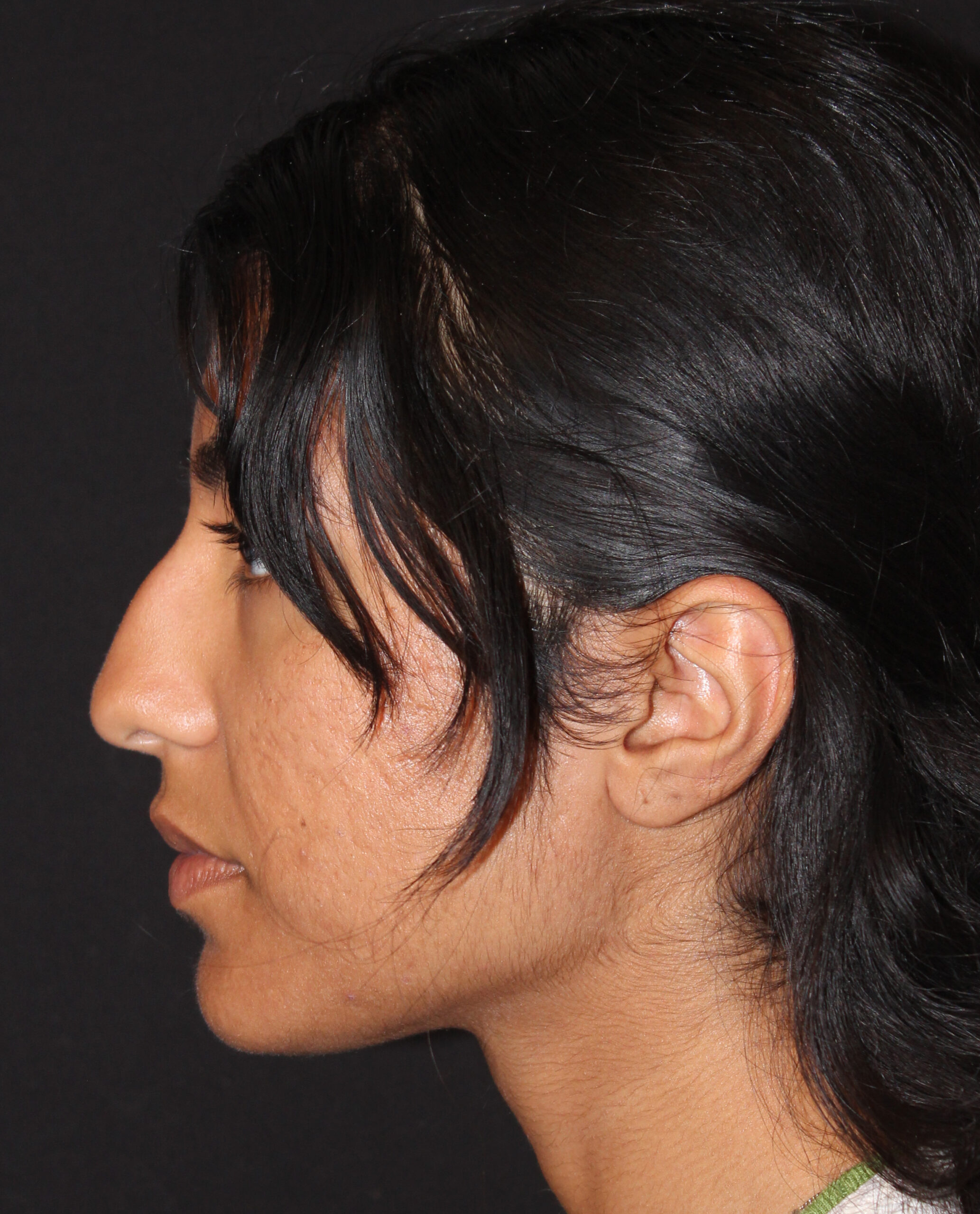 Patient #174 Before Image