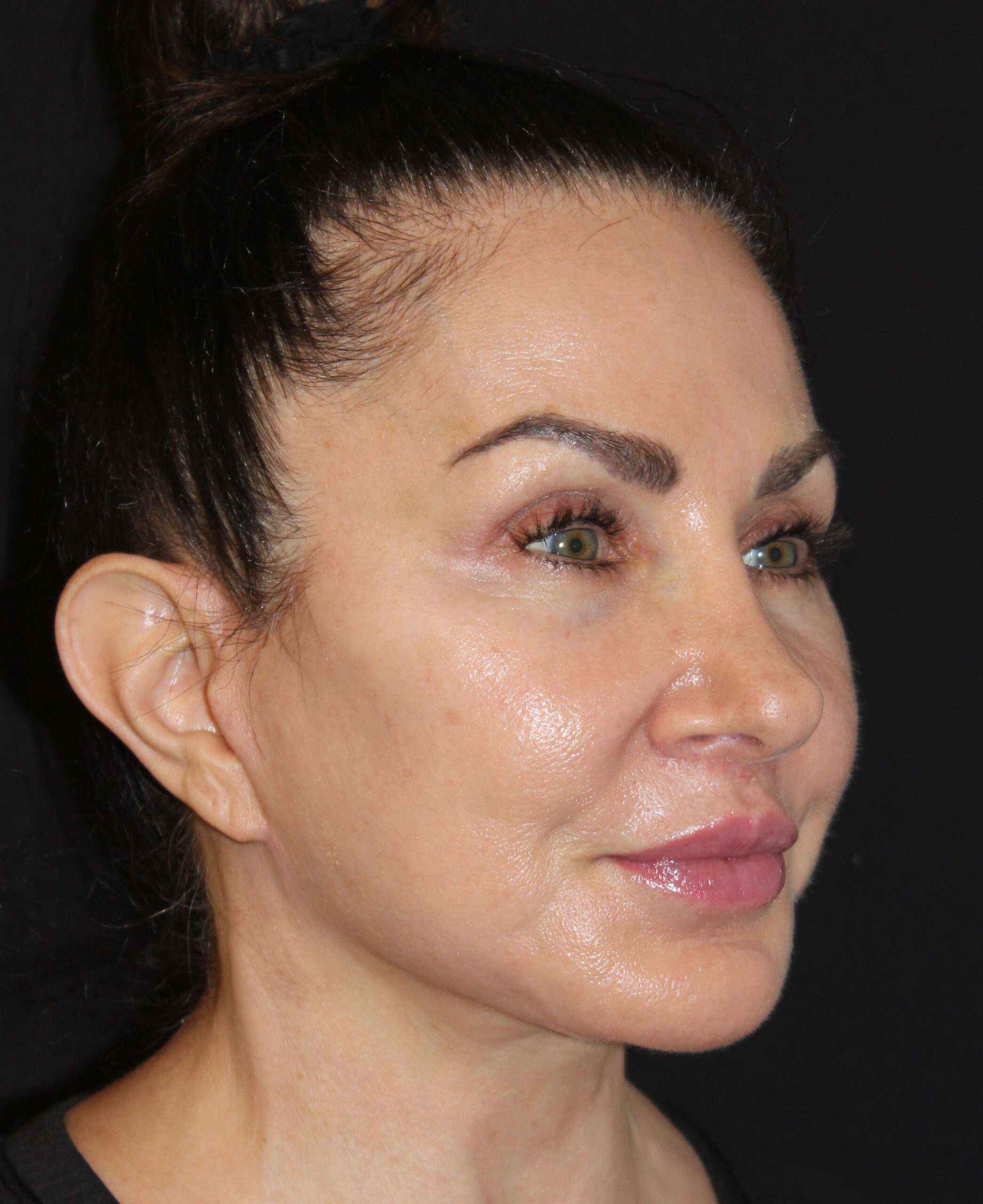 Patient 107 After Image