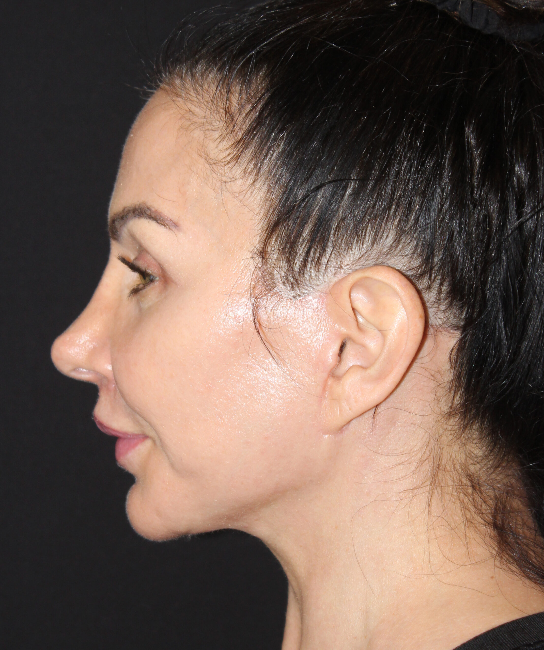 Patient 107 After Image