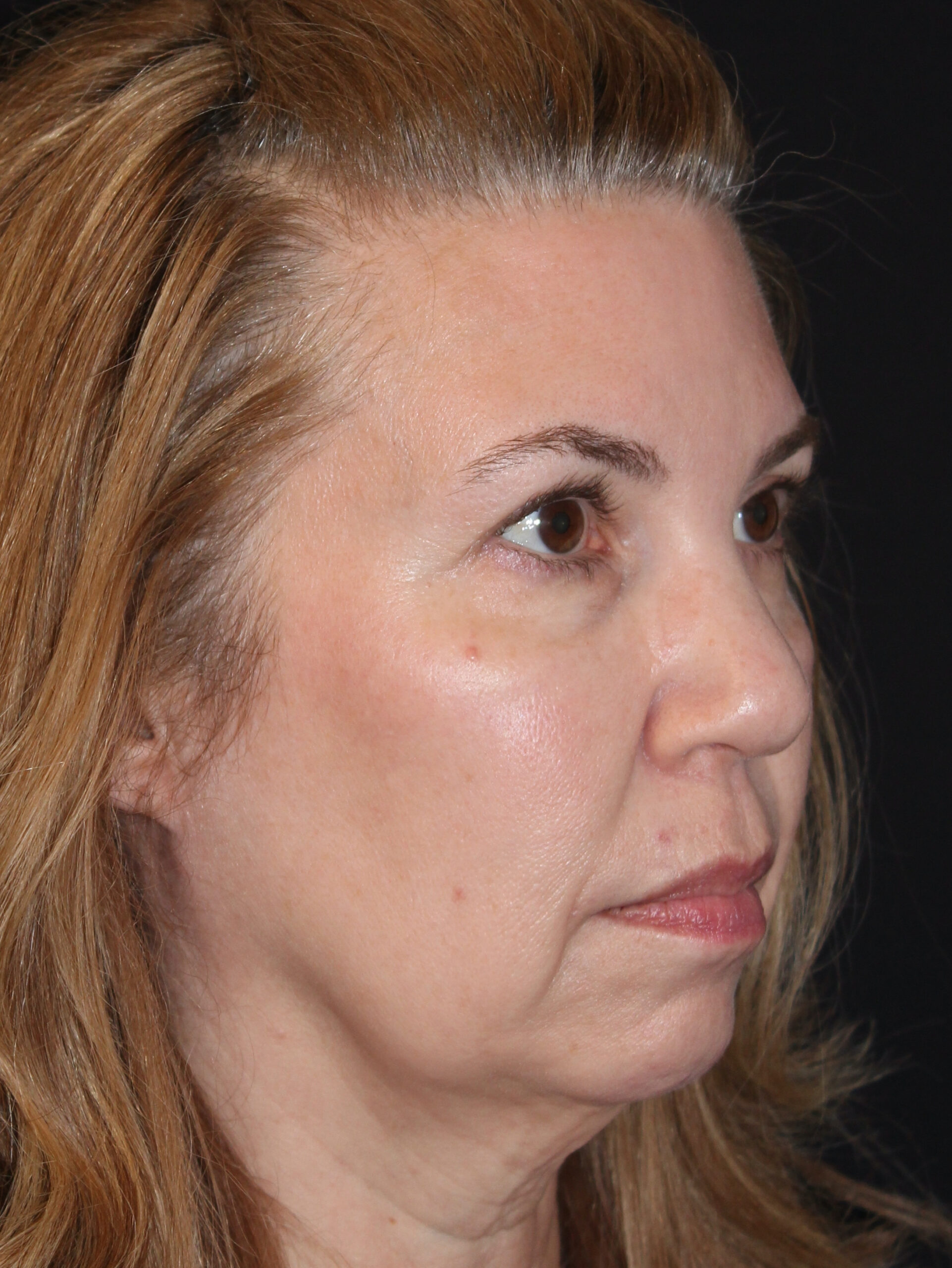 Patient 97 Before Image