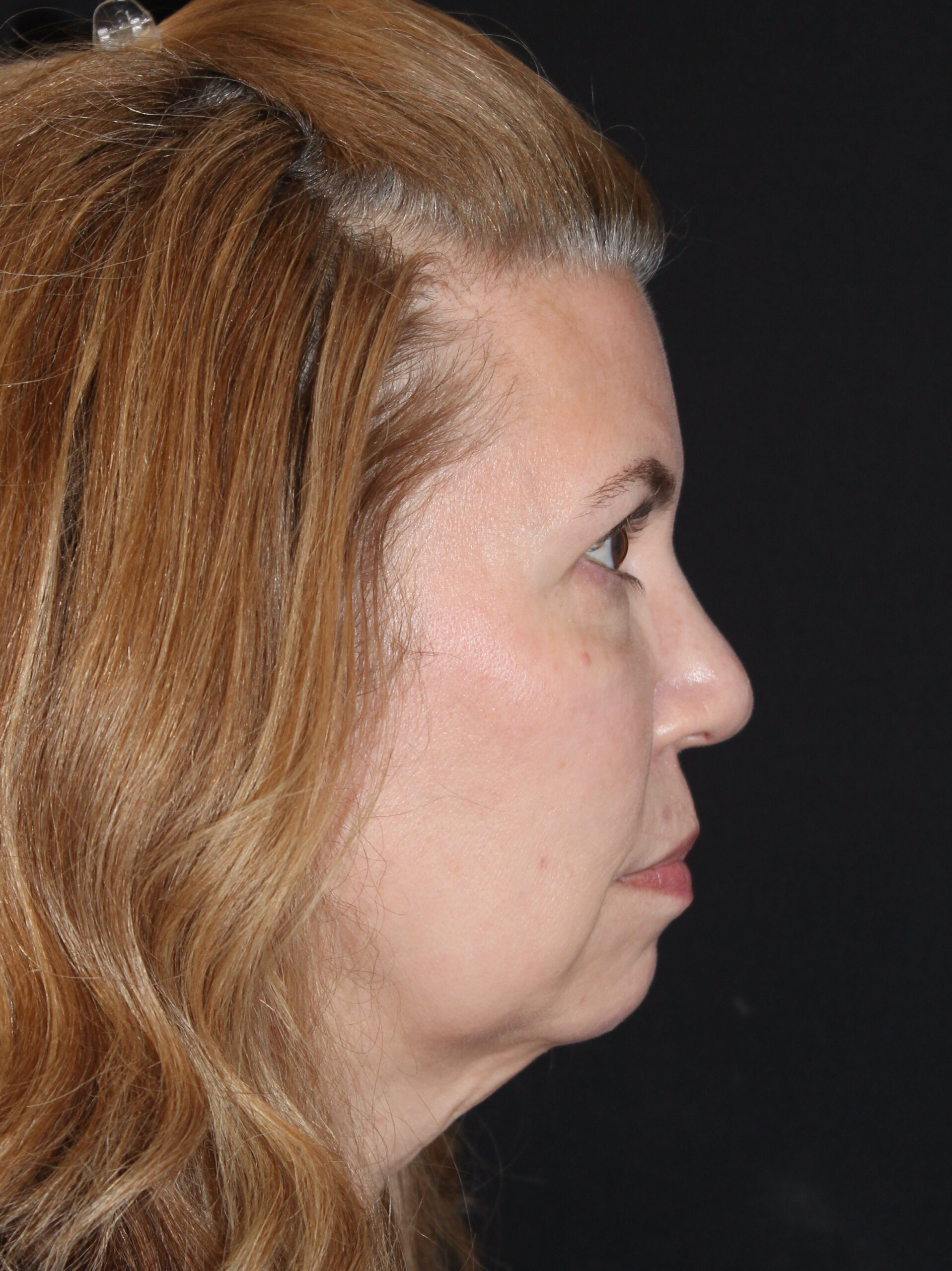 Patient 97 Before Image