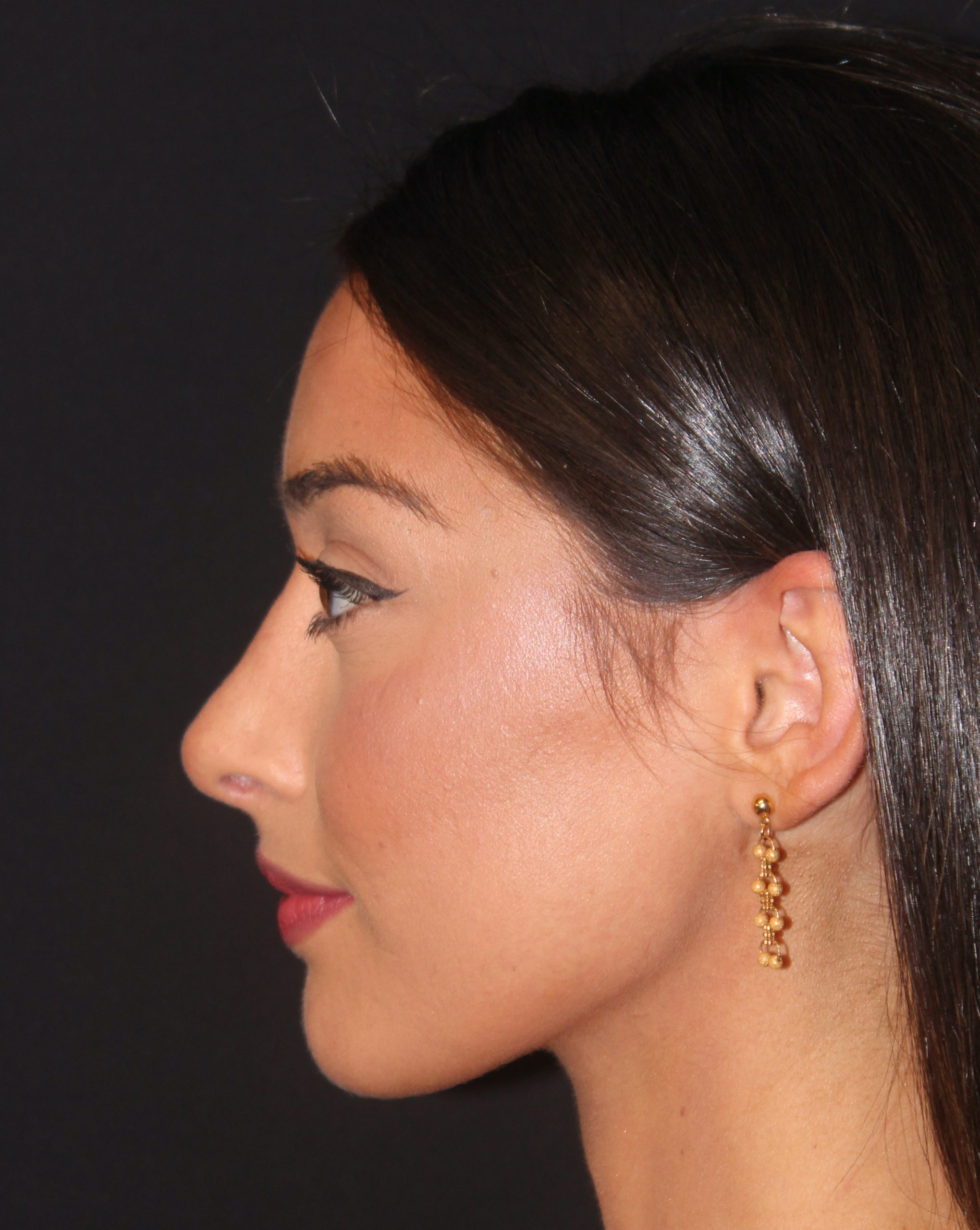 Patient 84 After Image