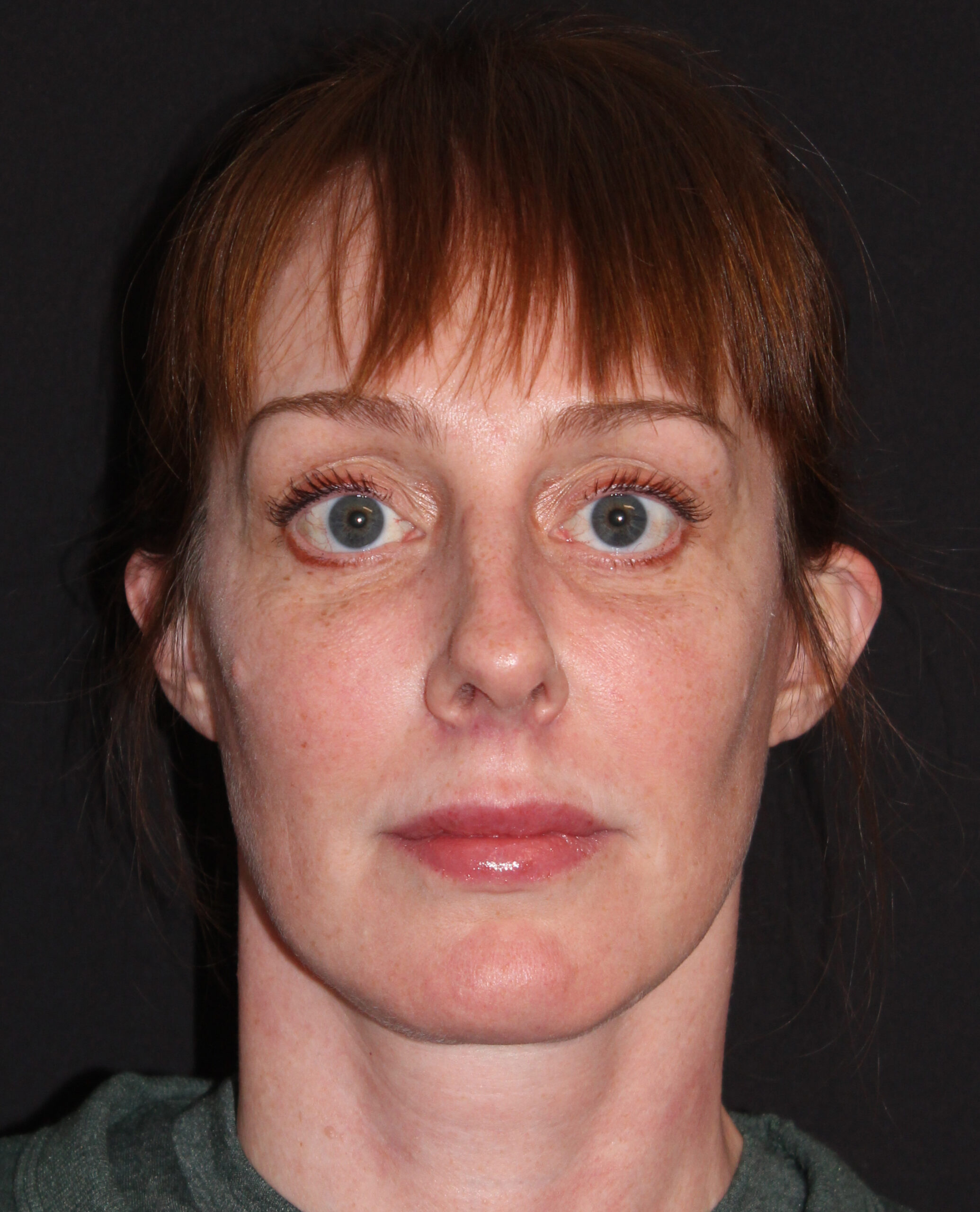 Patient #182 After Image