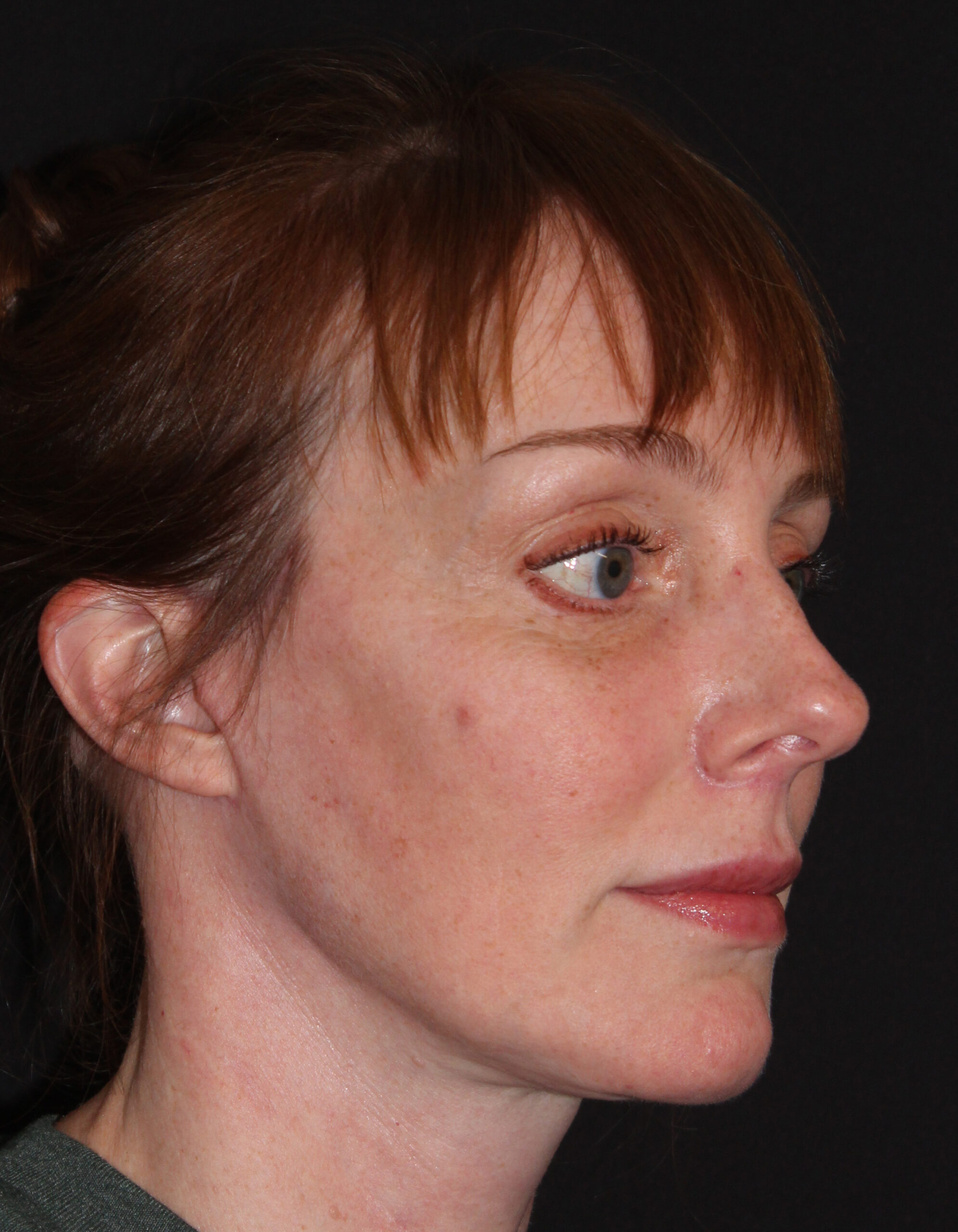 Patient #182 After Image