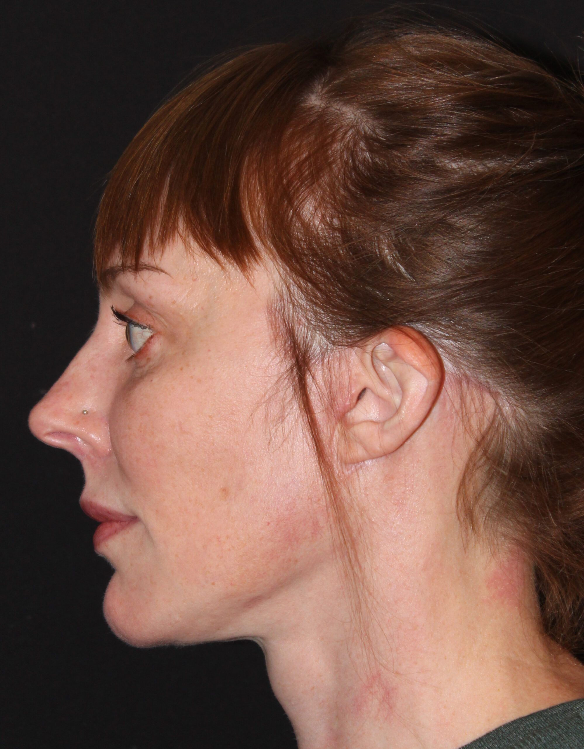 Patient #182 After Image