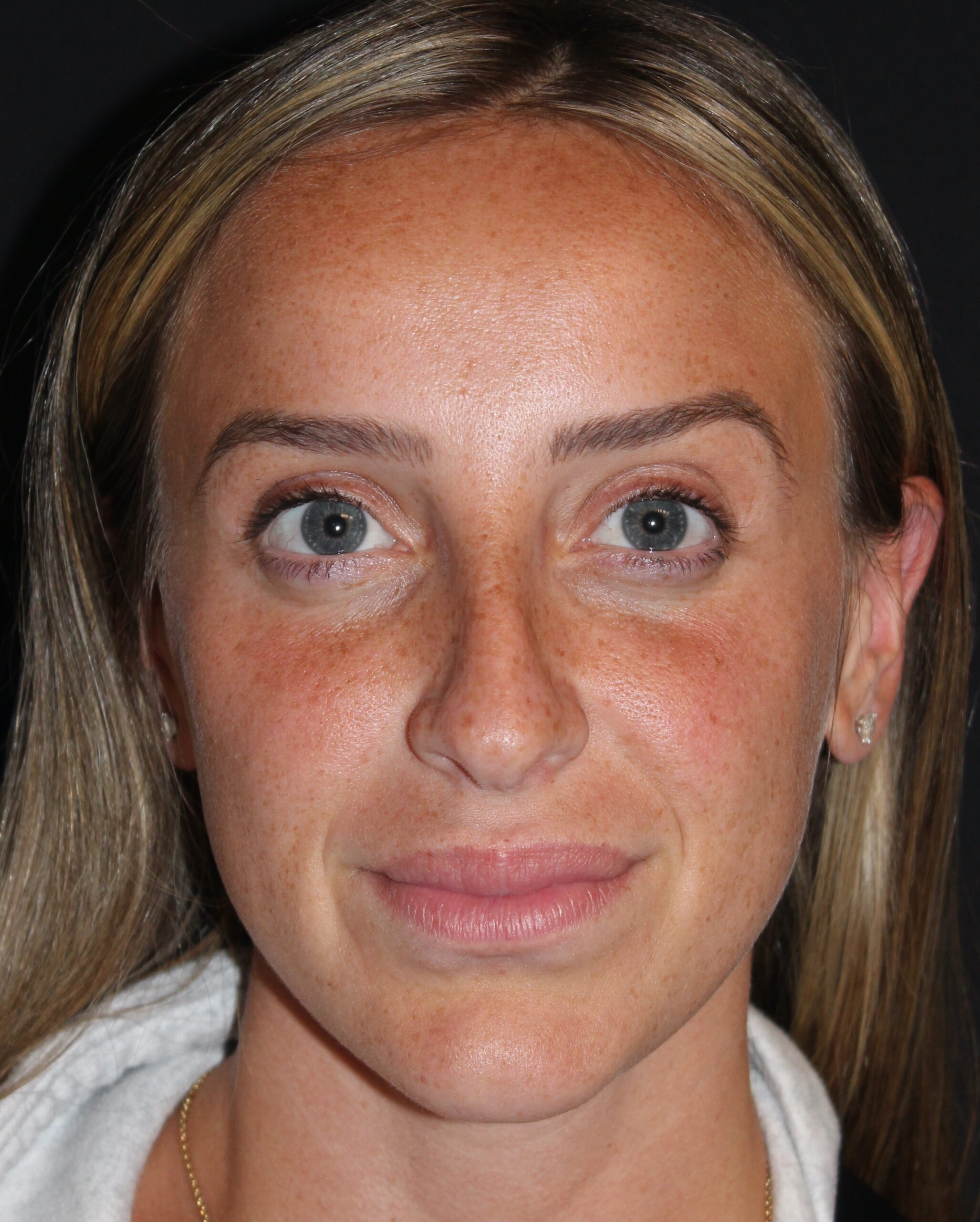 Patient #110 Before Image