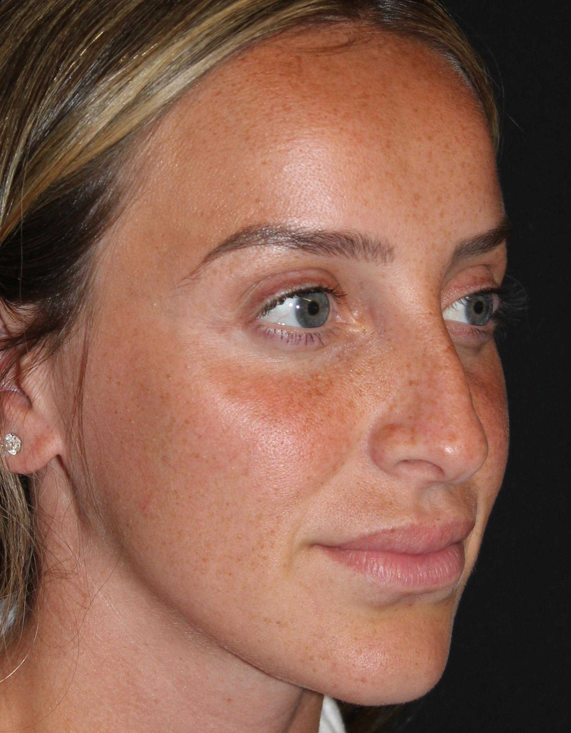 Patient #110 Before Image