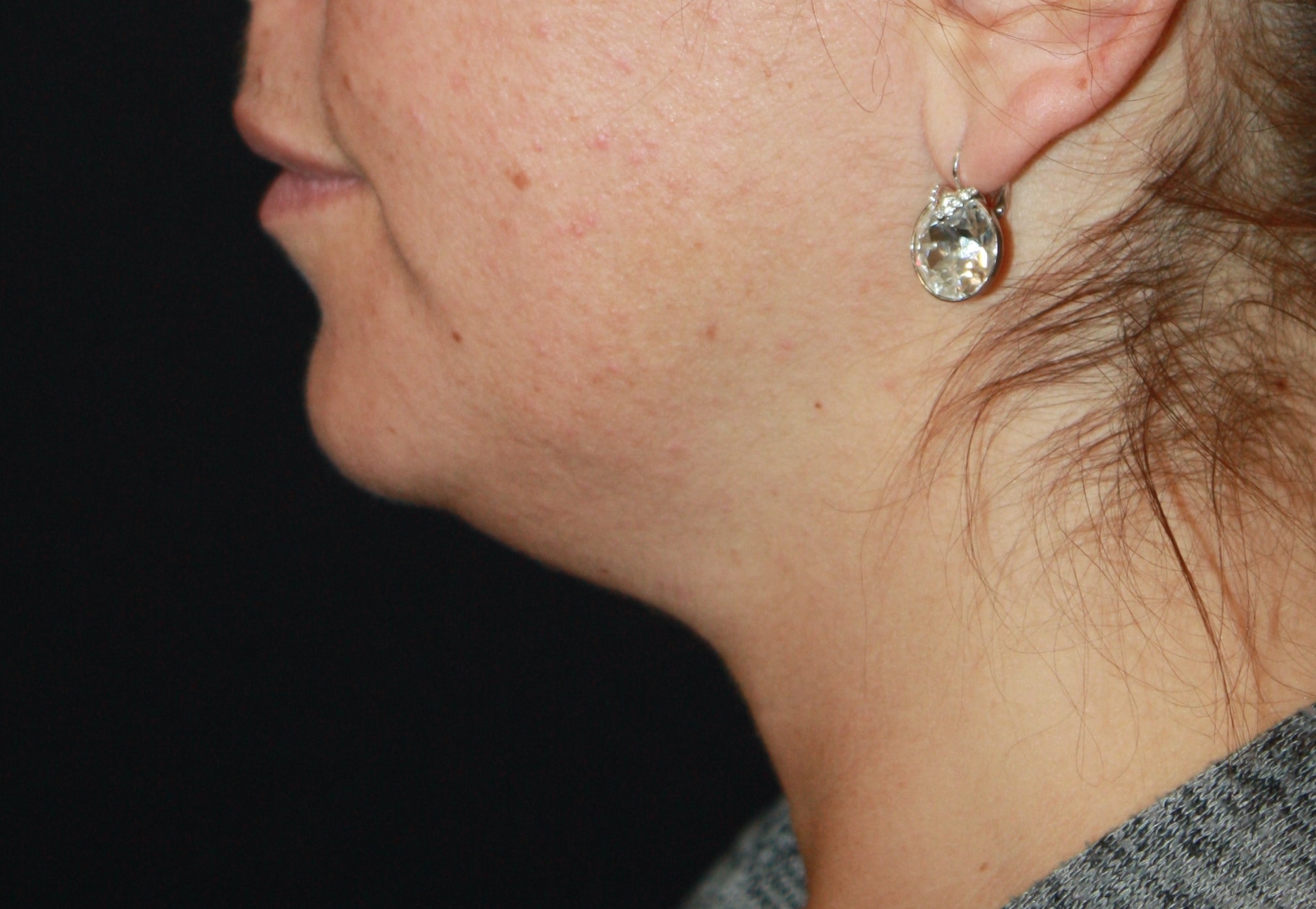 Patient 89 Before Image