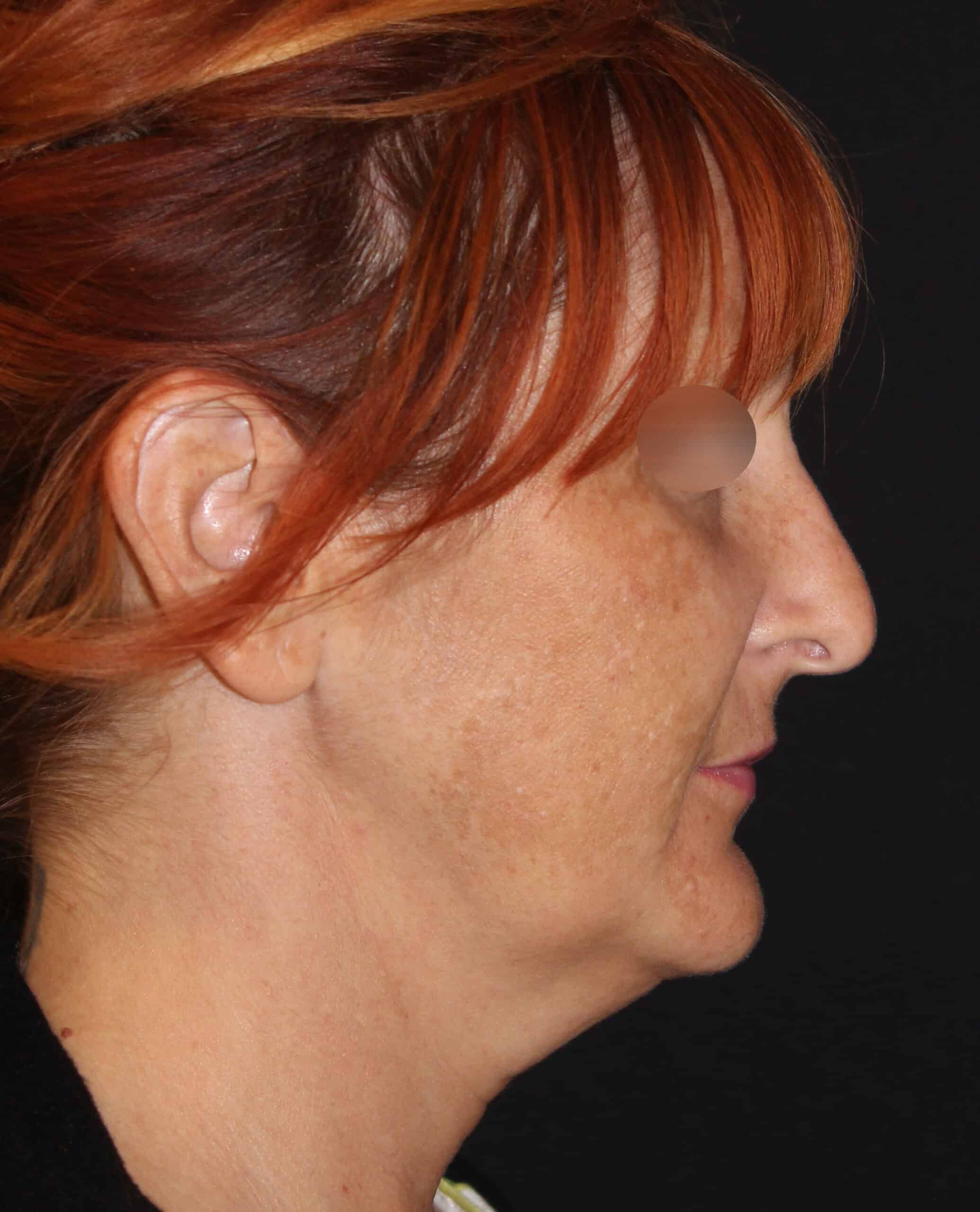 Patient 96 Before Image