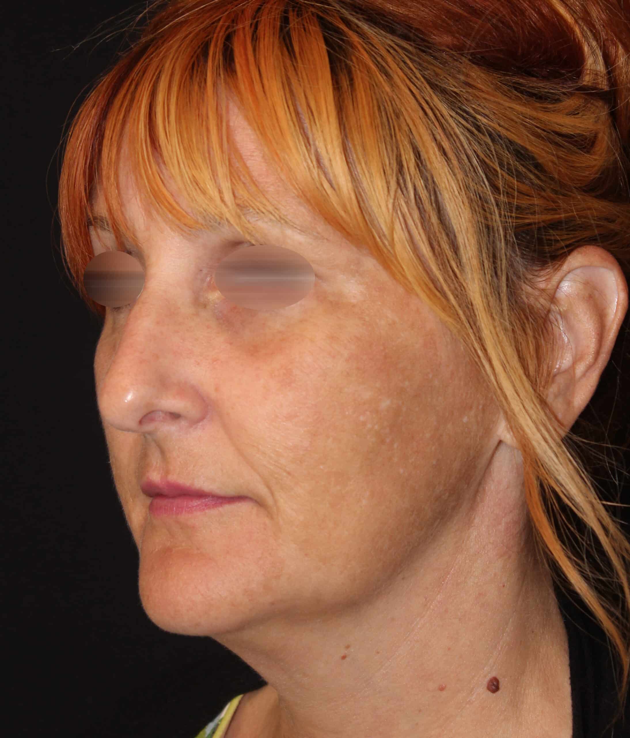 Patient 96 Before Image