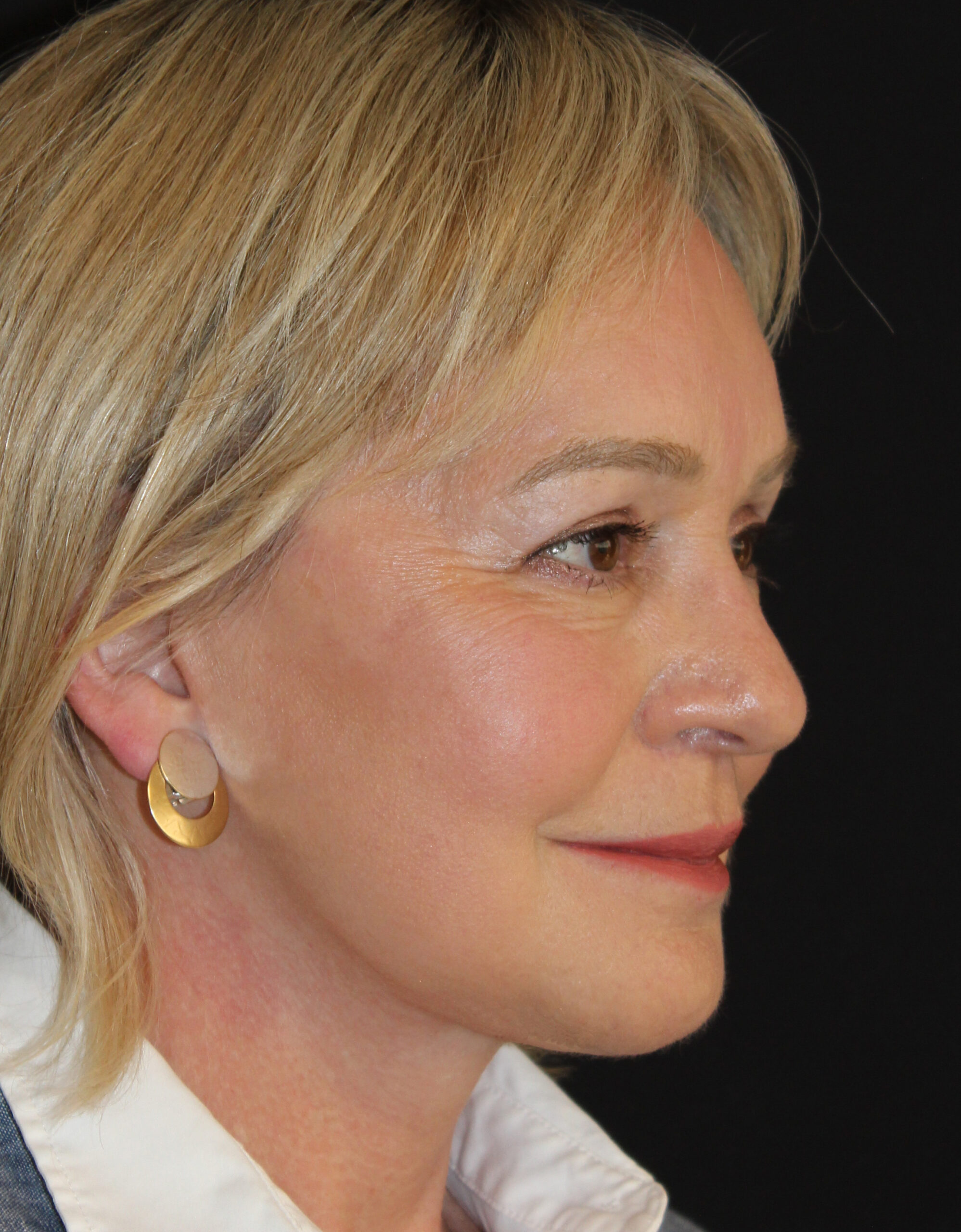 Patient 99 After Image