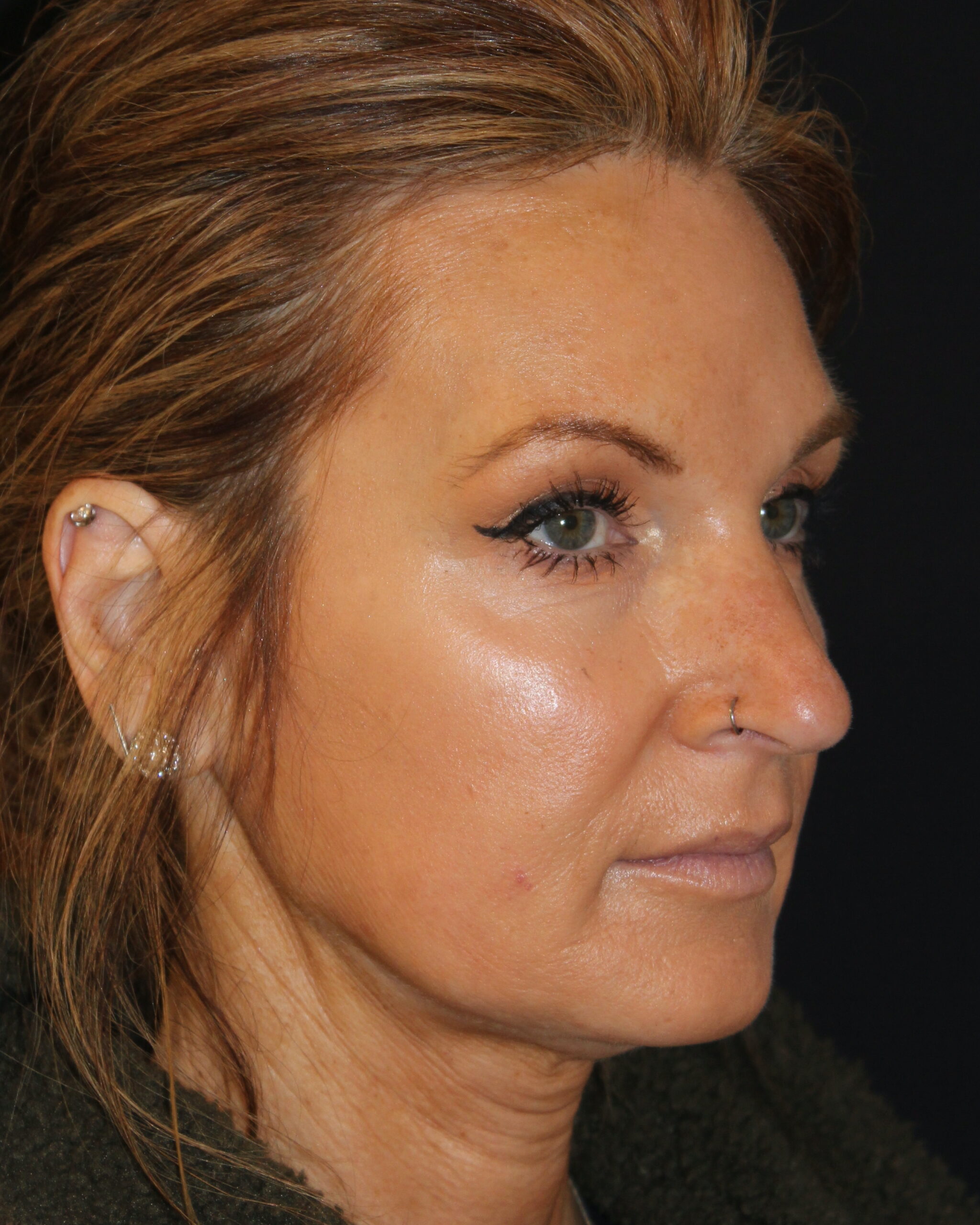 Patient #168 Before Image