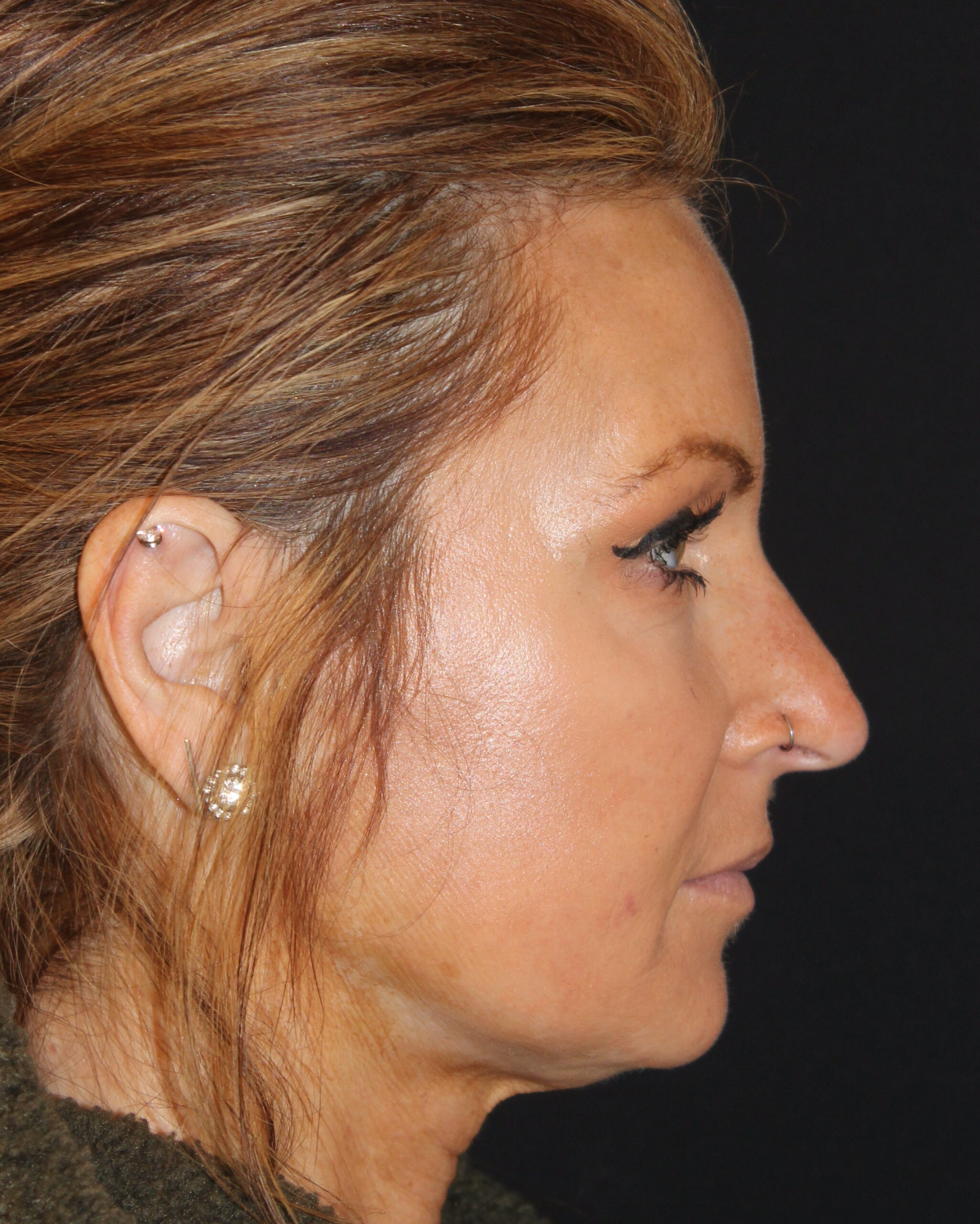 Patient #168 Before Image