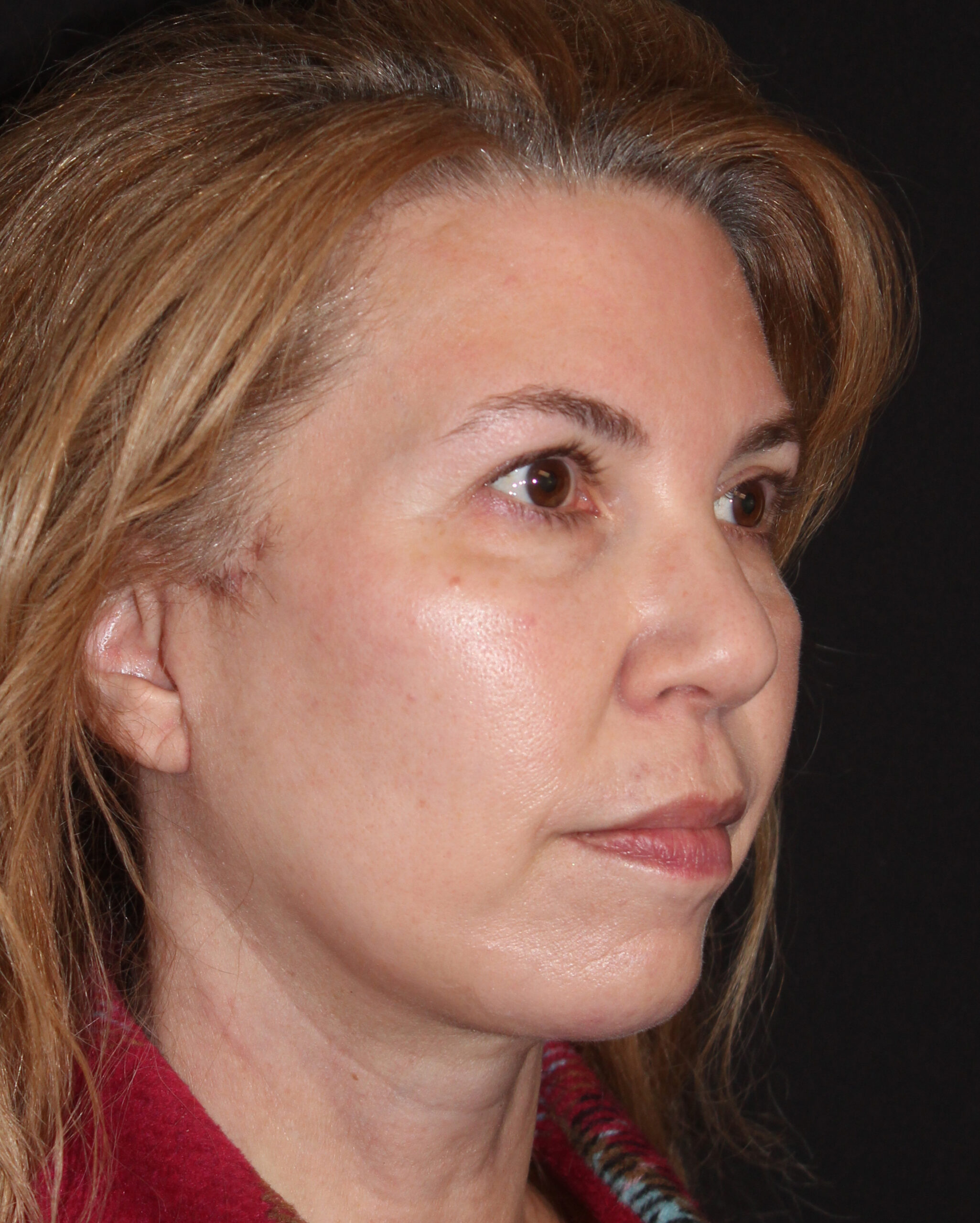 Patient 97 After Image