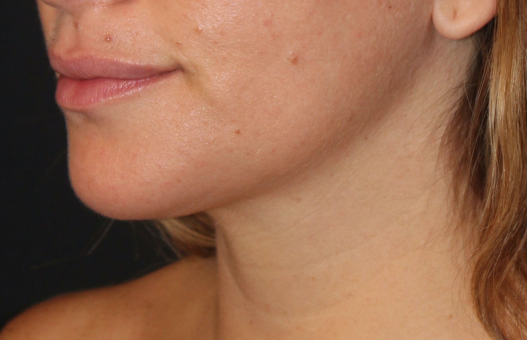 Patient 89 After Image