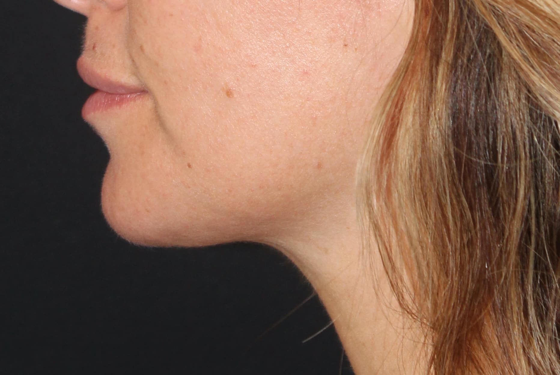 Patient 89 After Image