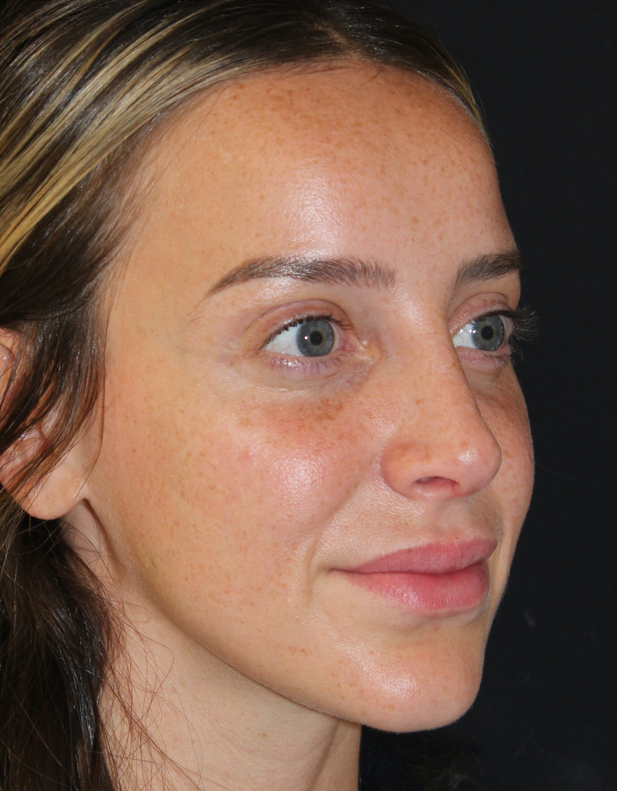 Patient #110 After Image