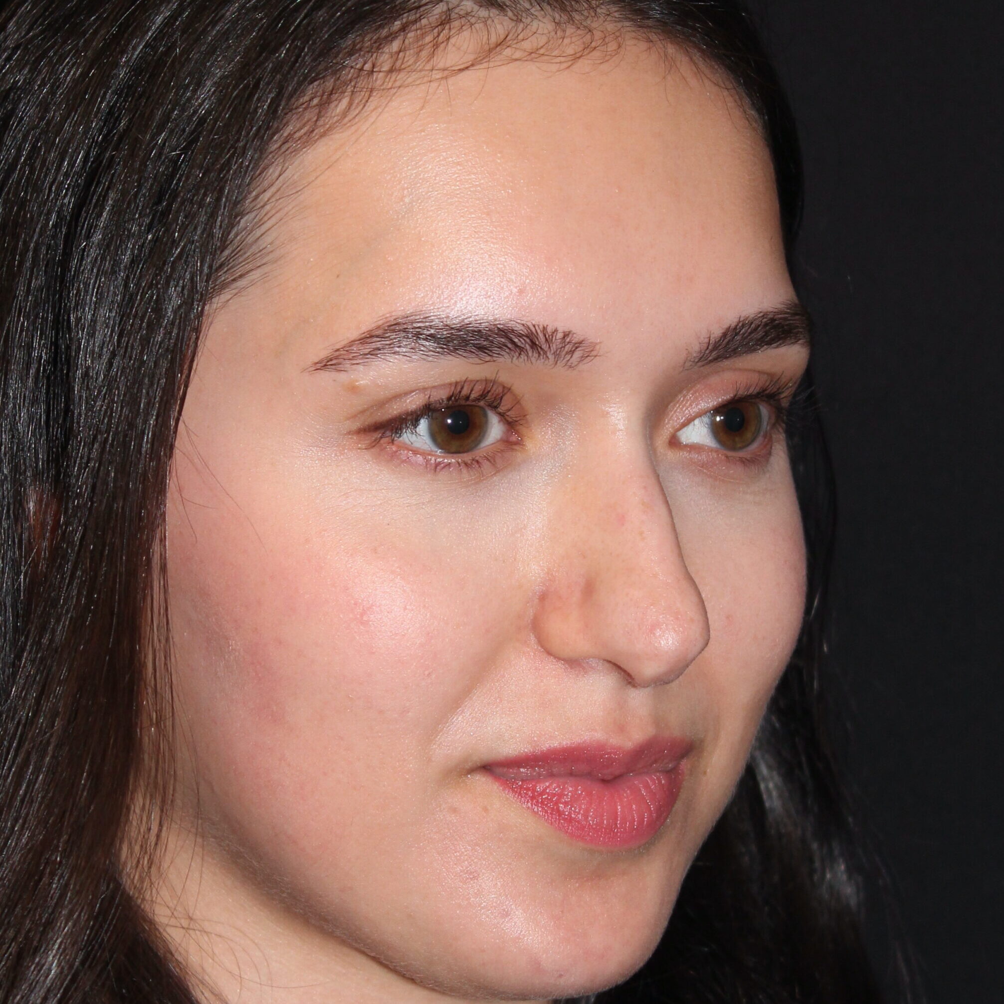 Patient #171 Before Image