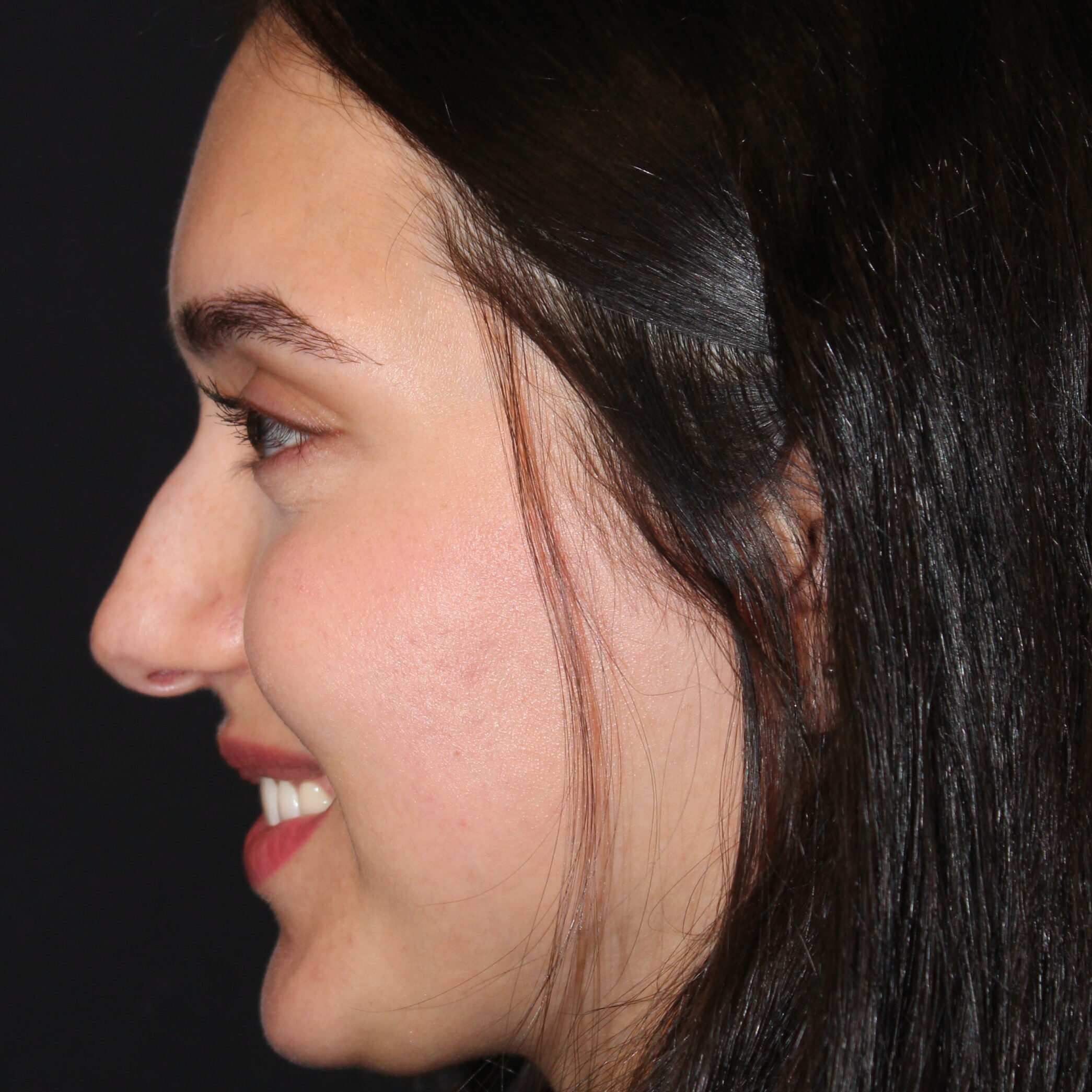 Patient #171 Before Image