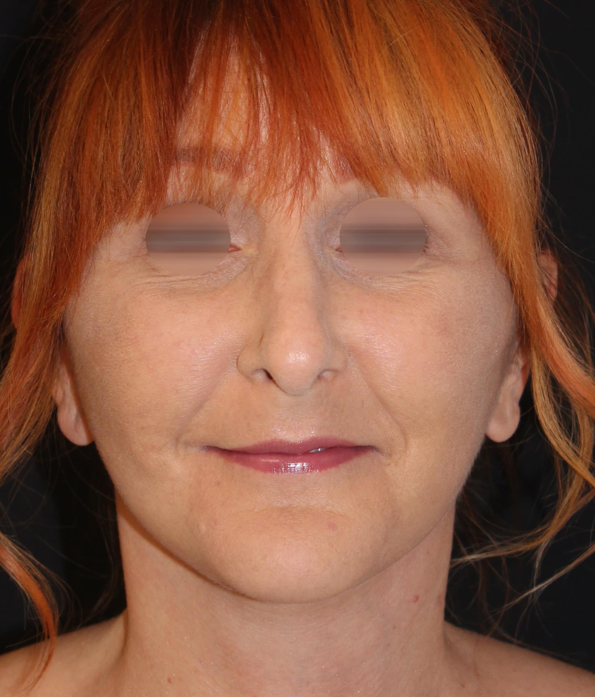 Patient 96 After Image