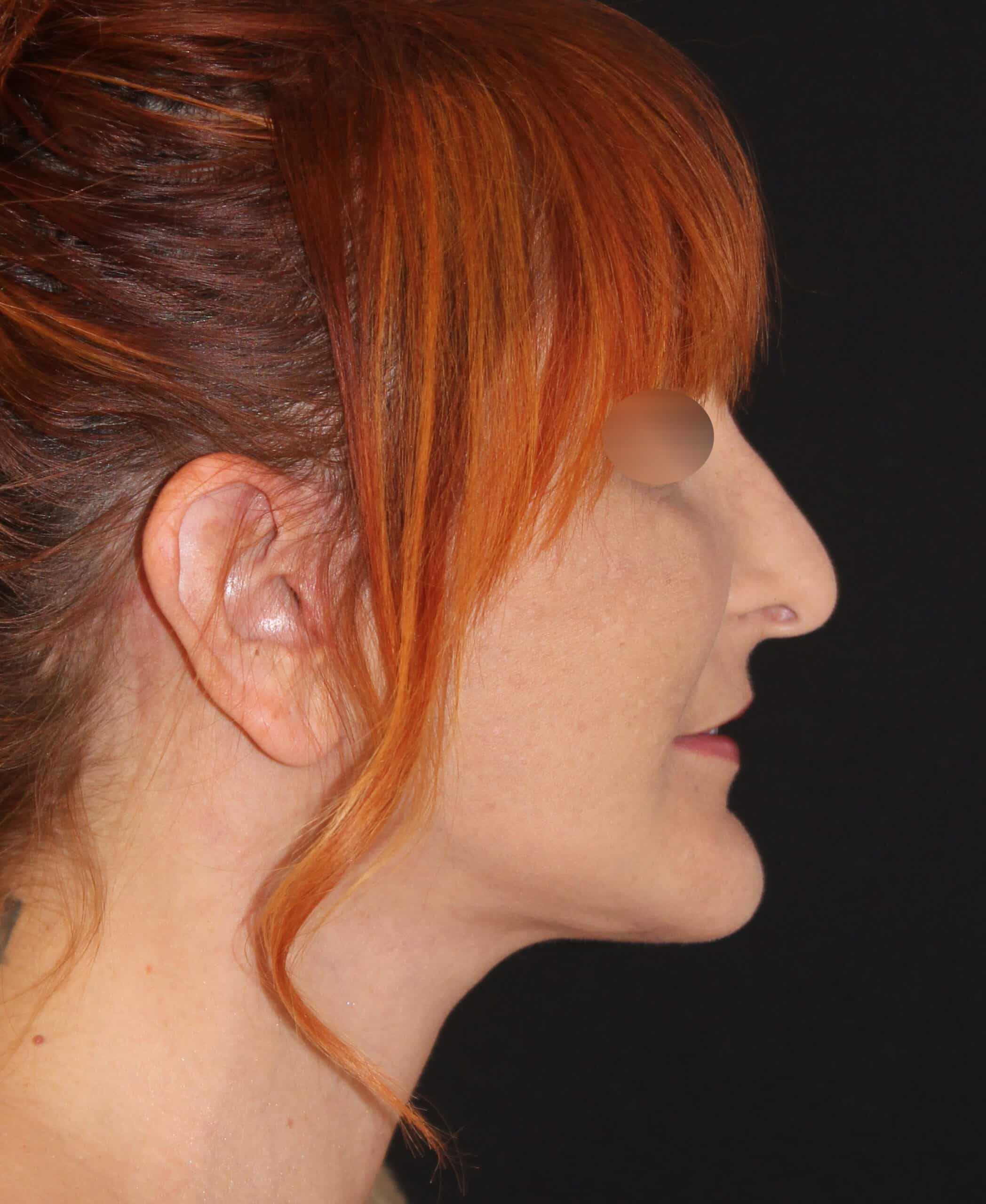 Patient 96 After Image