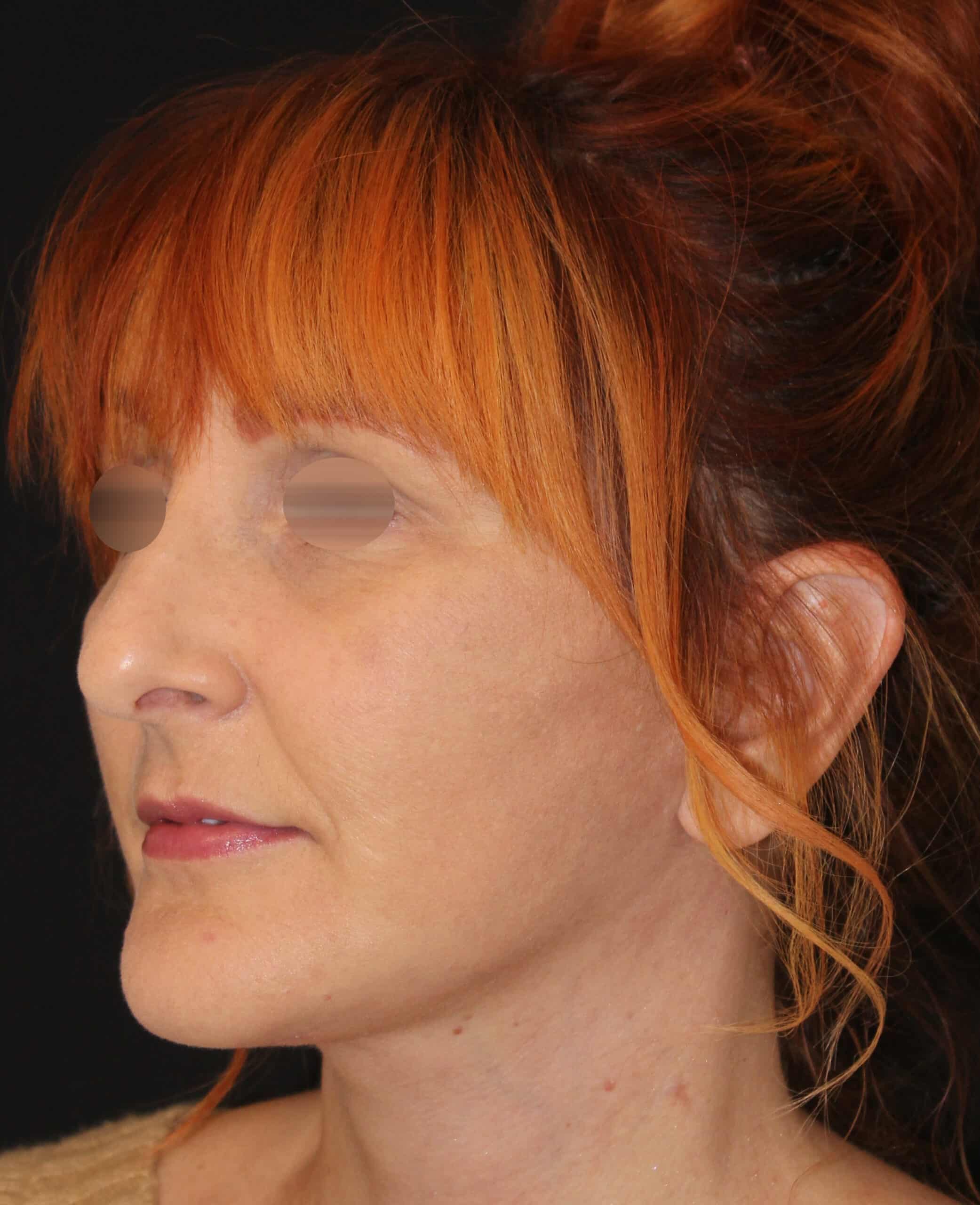 Patient 96 After Image