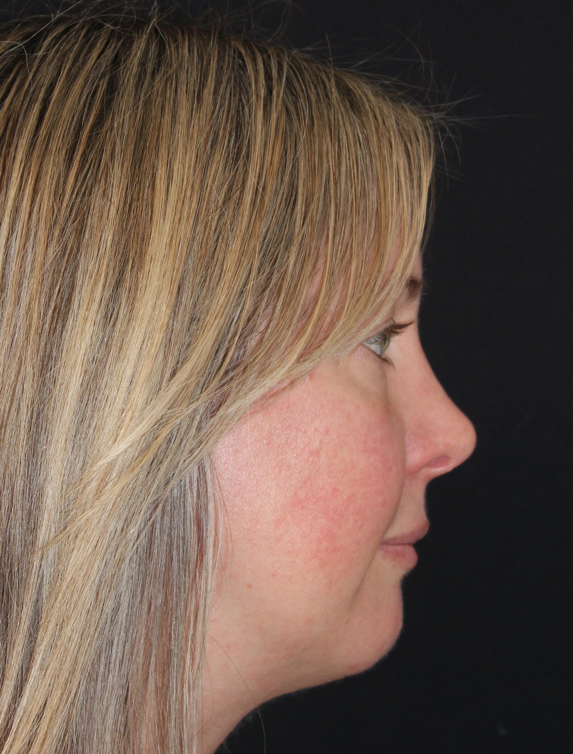 Patient 105 Before Image