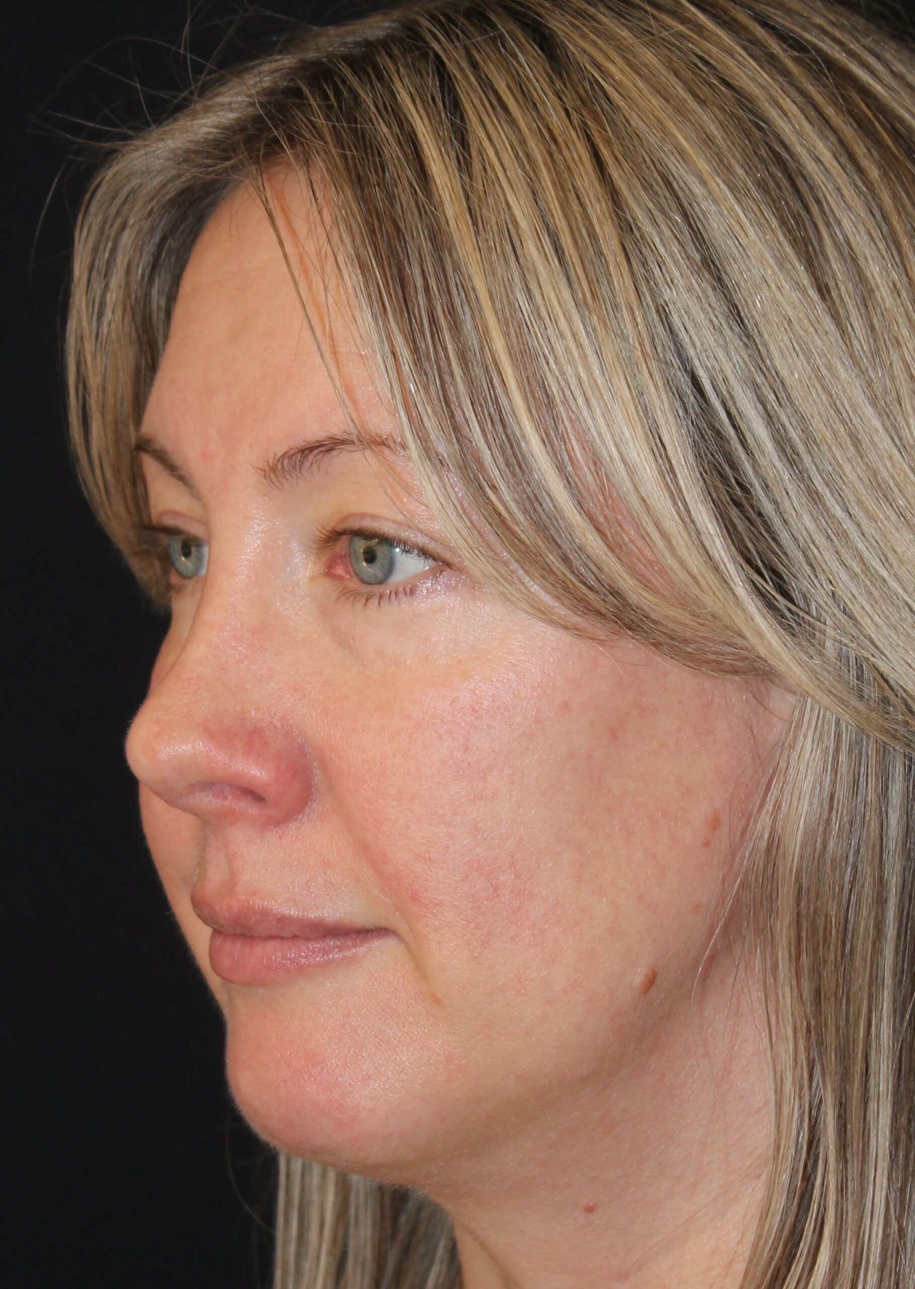 Patient 105 Before Image