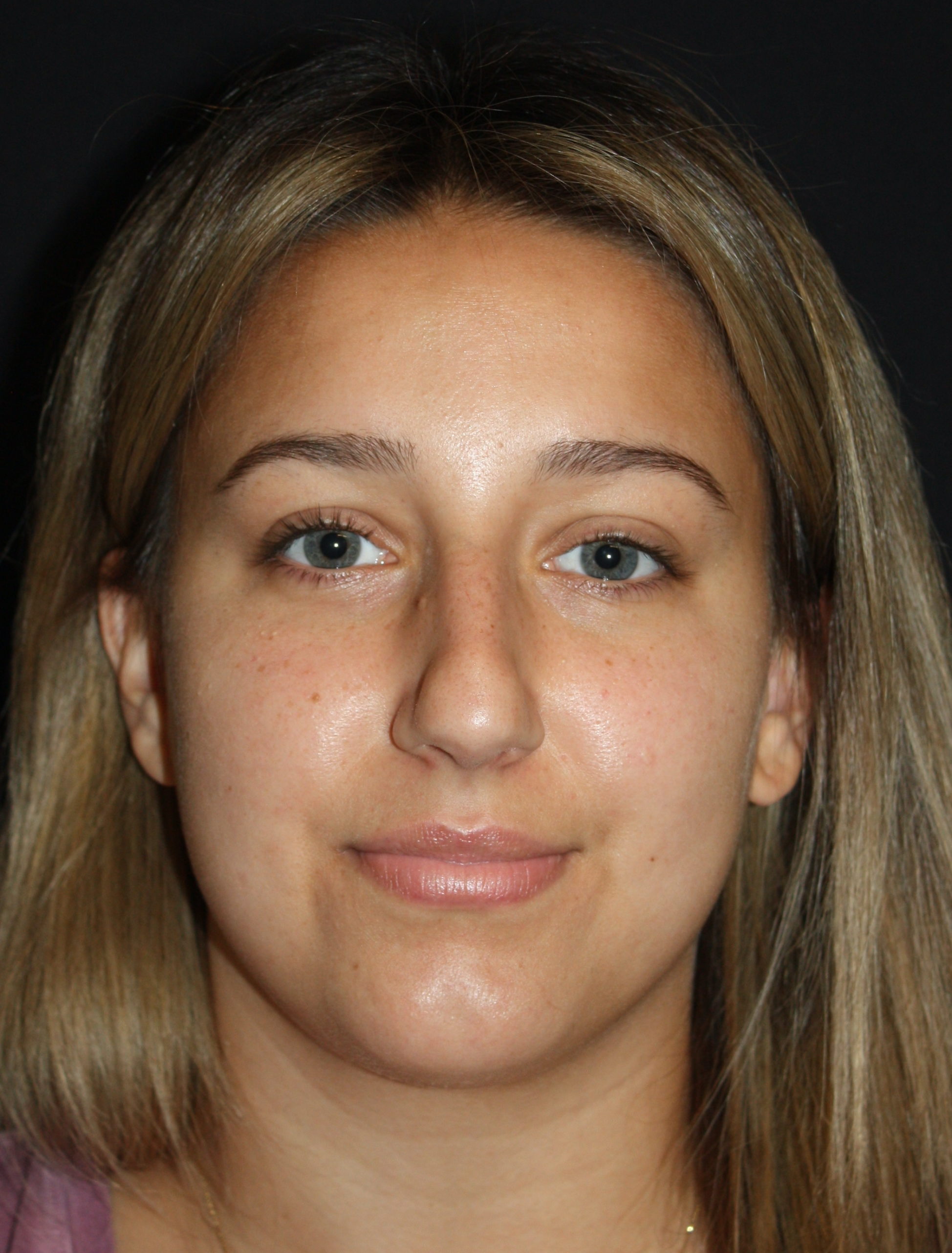 Patient 68 Before Image