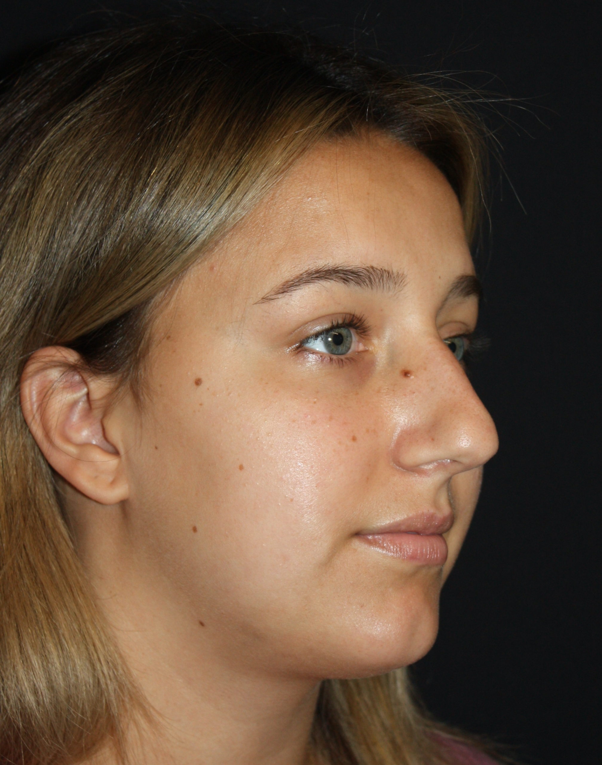 Patient 68 Before Image