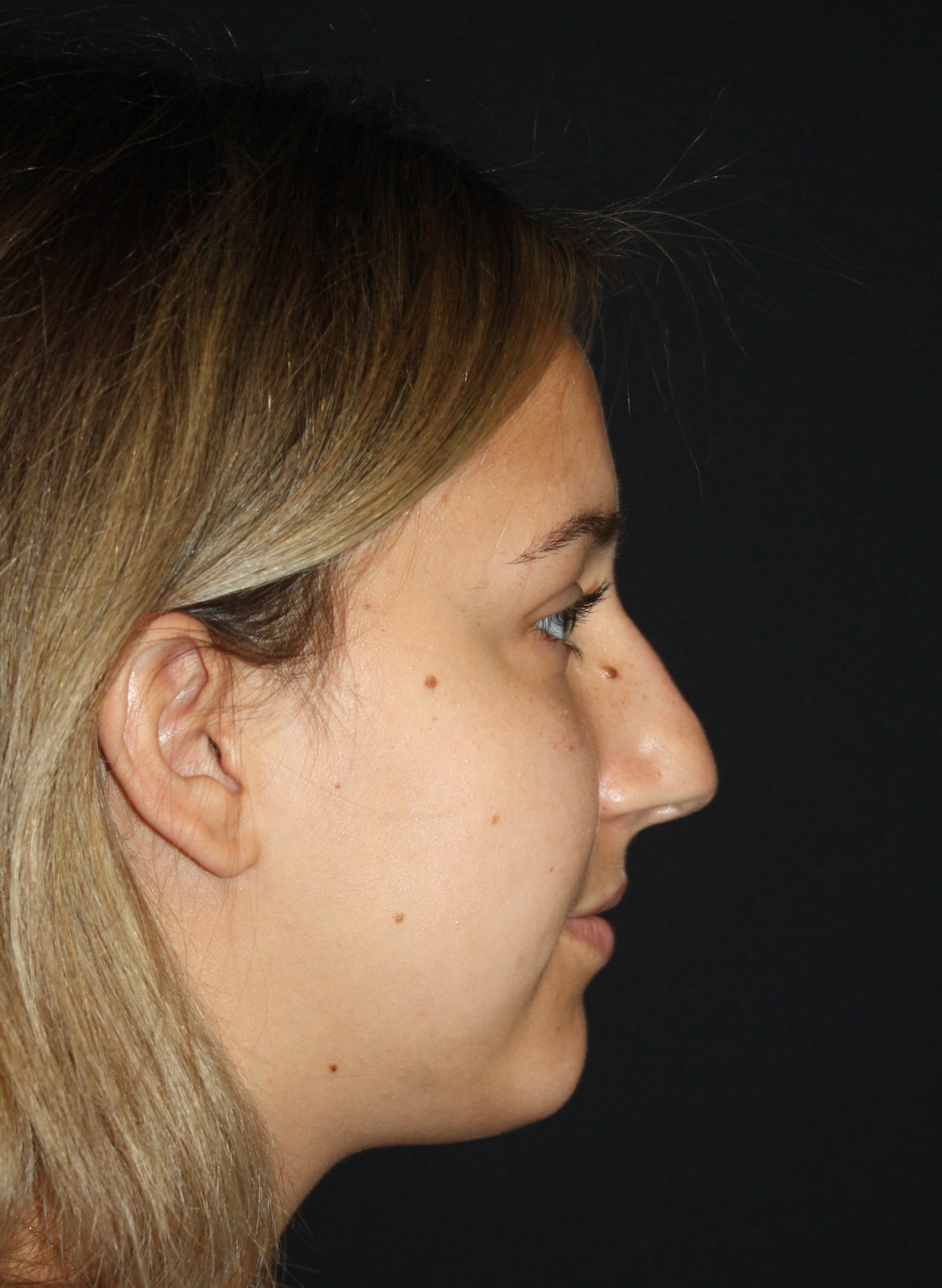 Patient 68 Before Image