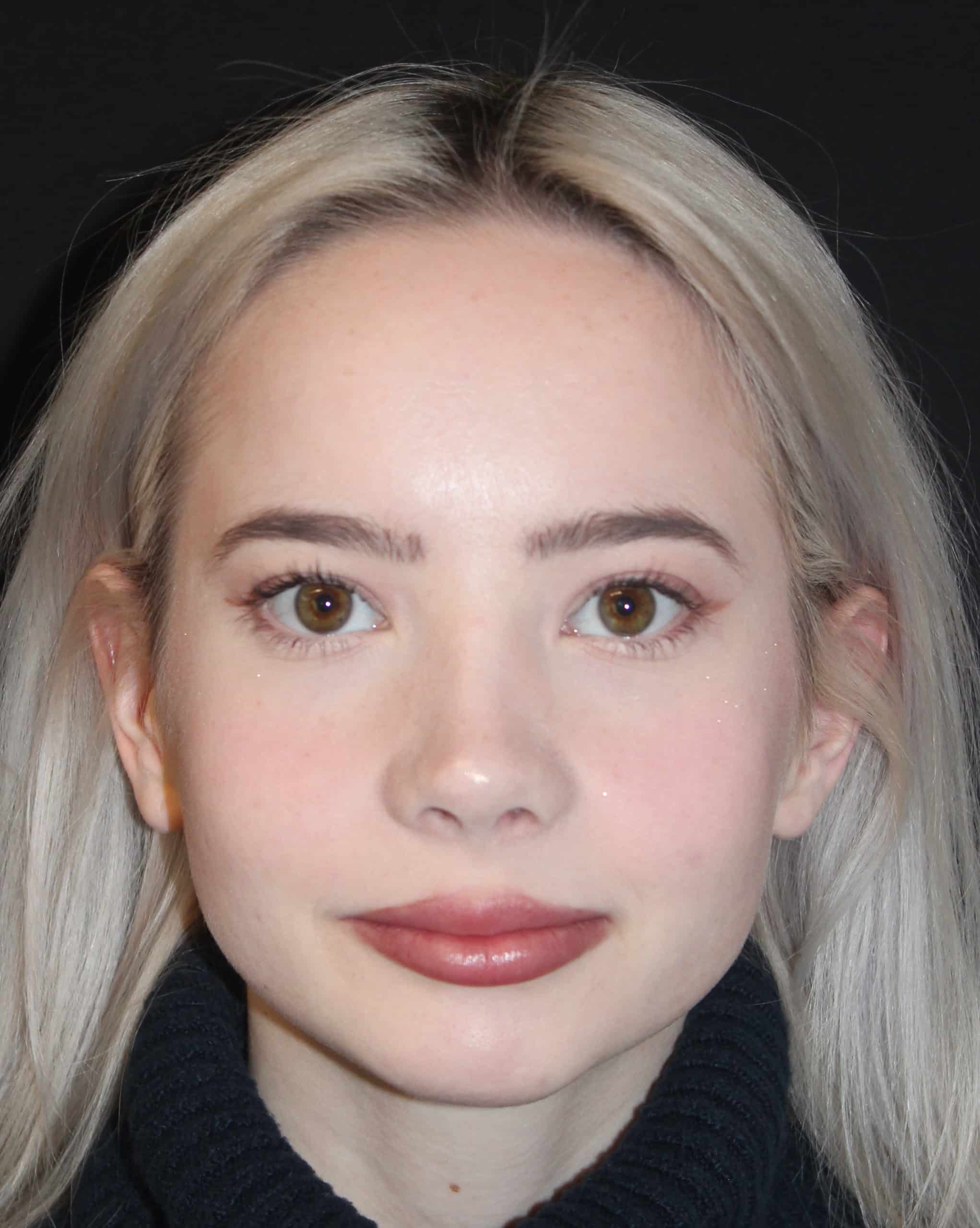 Patient 87 After Image