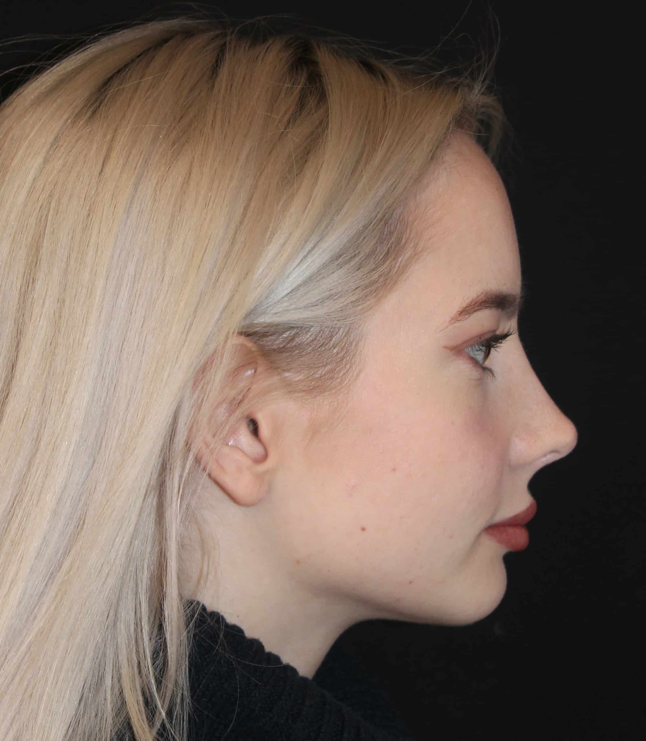 Patient 87 After Image