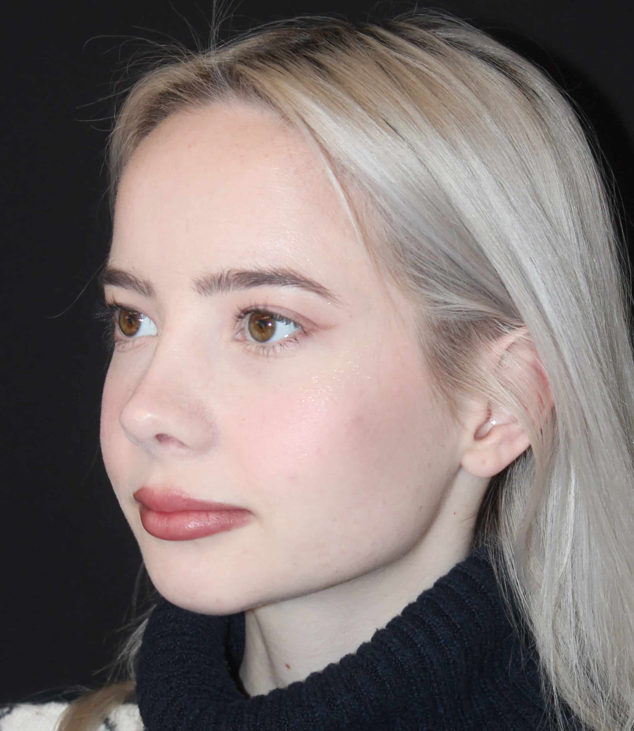 Patient 87 After Image