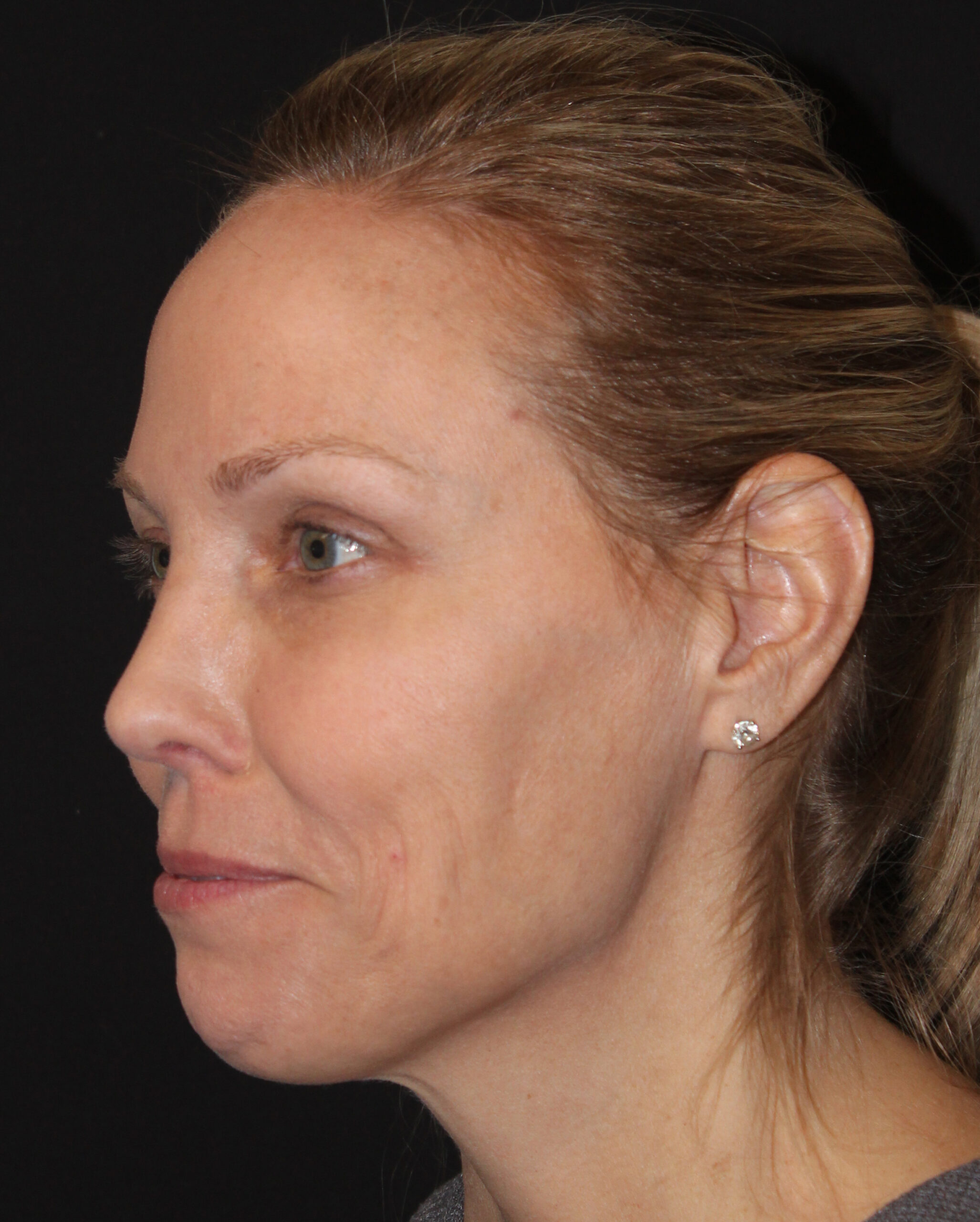 Patient 103 After Image