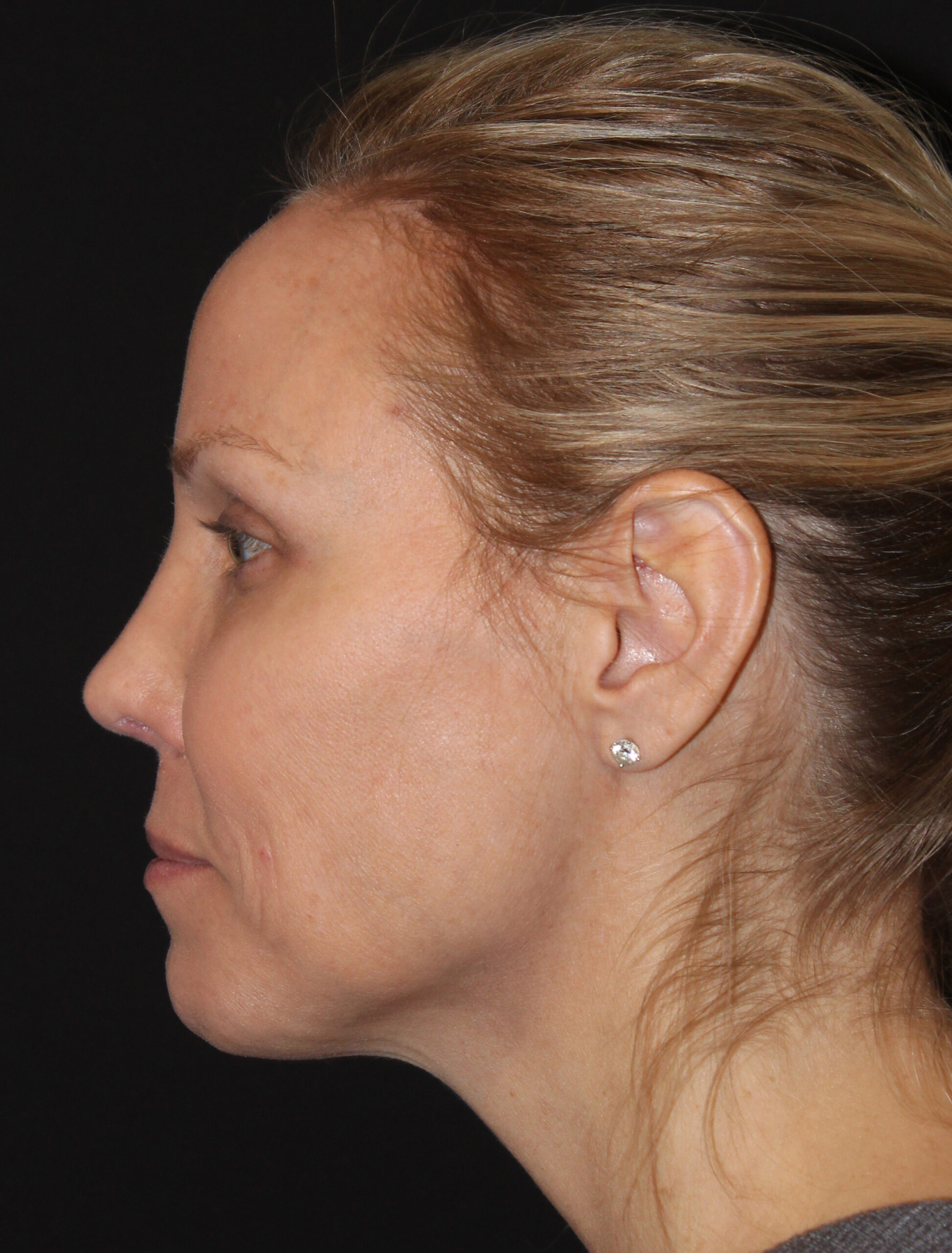 Patient 103 After Image