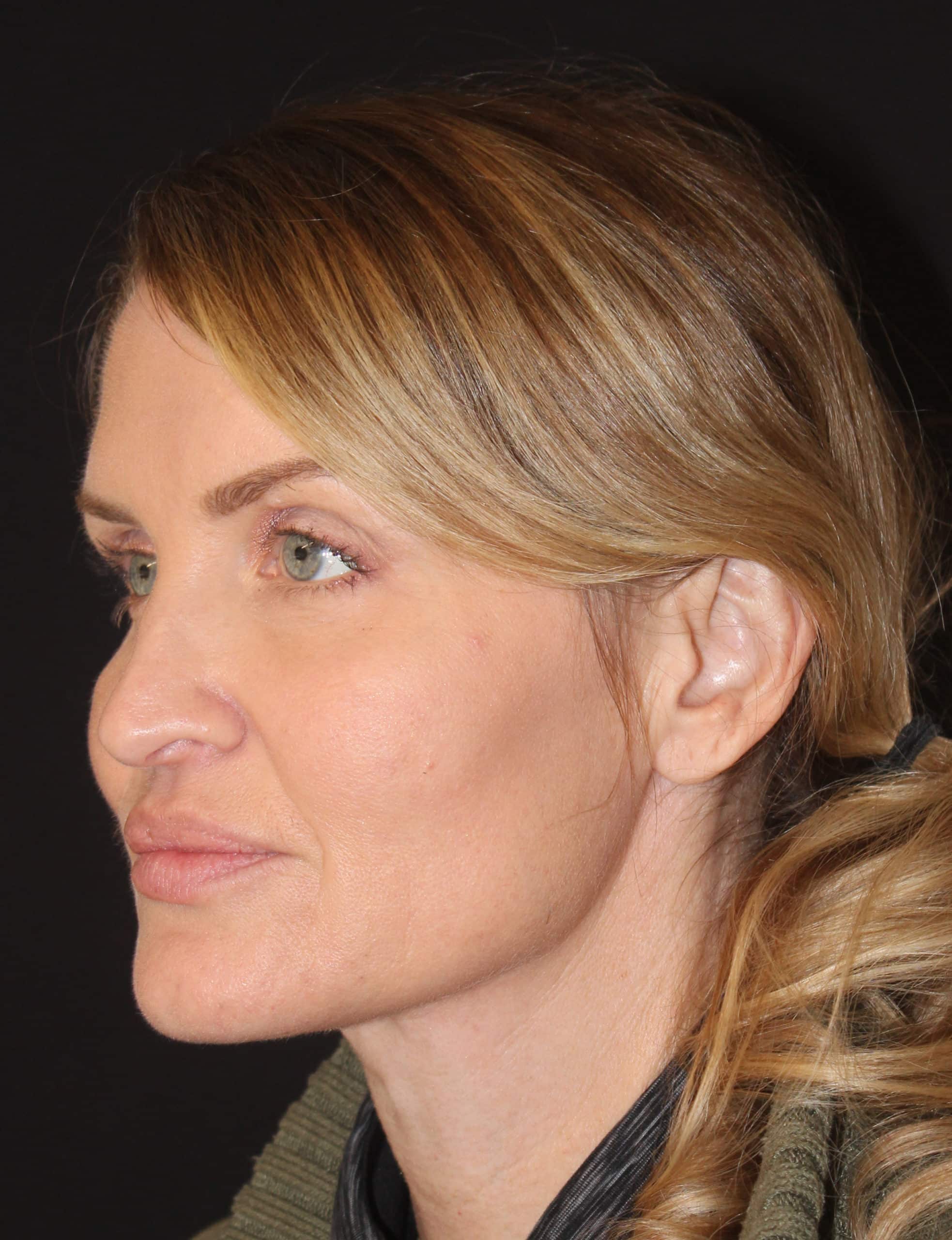 Patient #91 After Image