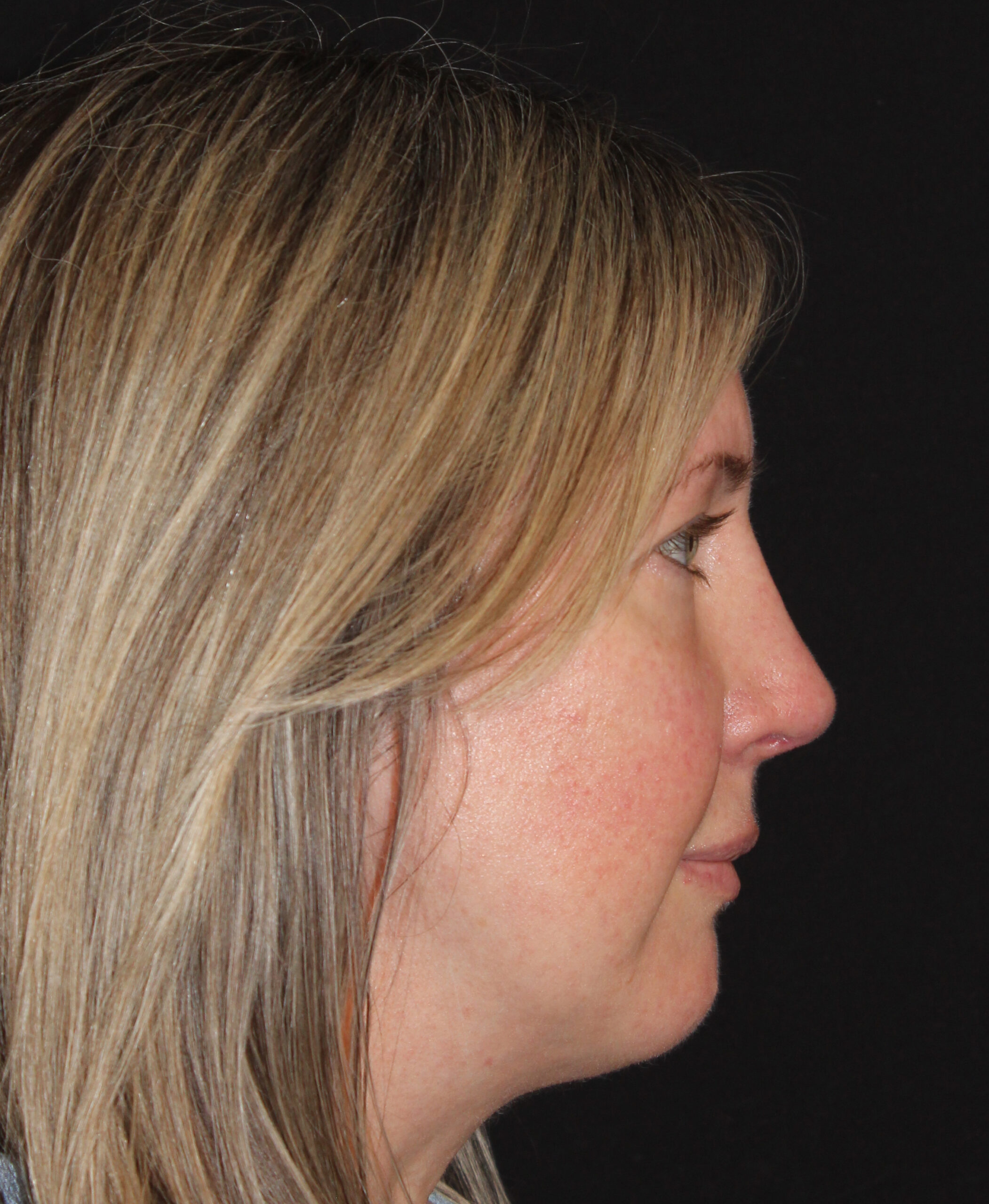 Patient 105 After Image