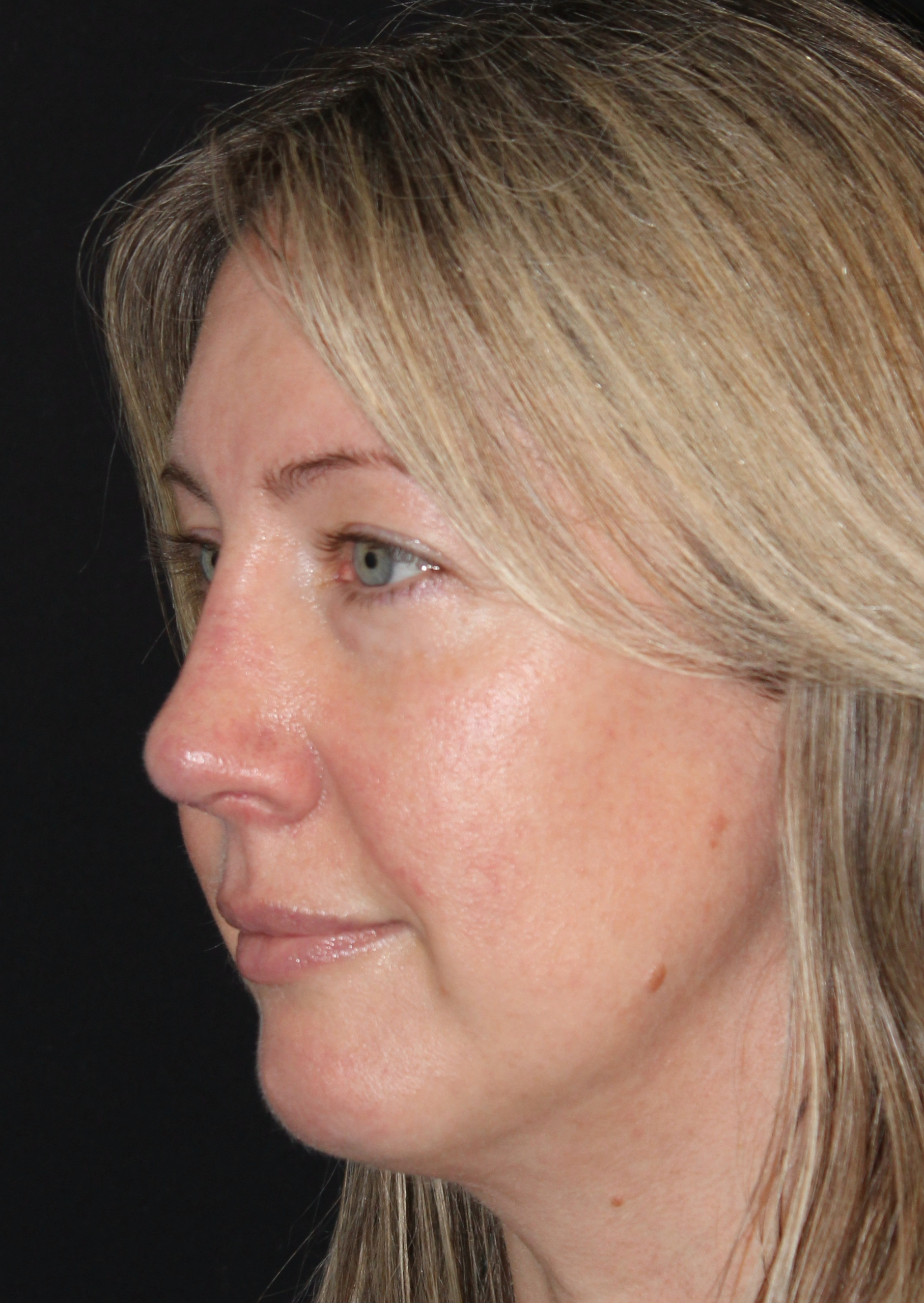 Patient 105 After Image