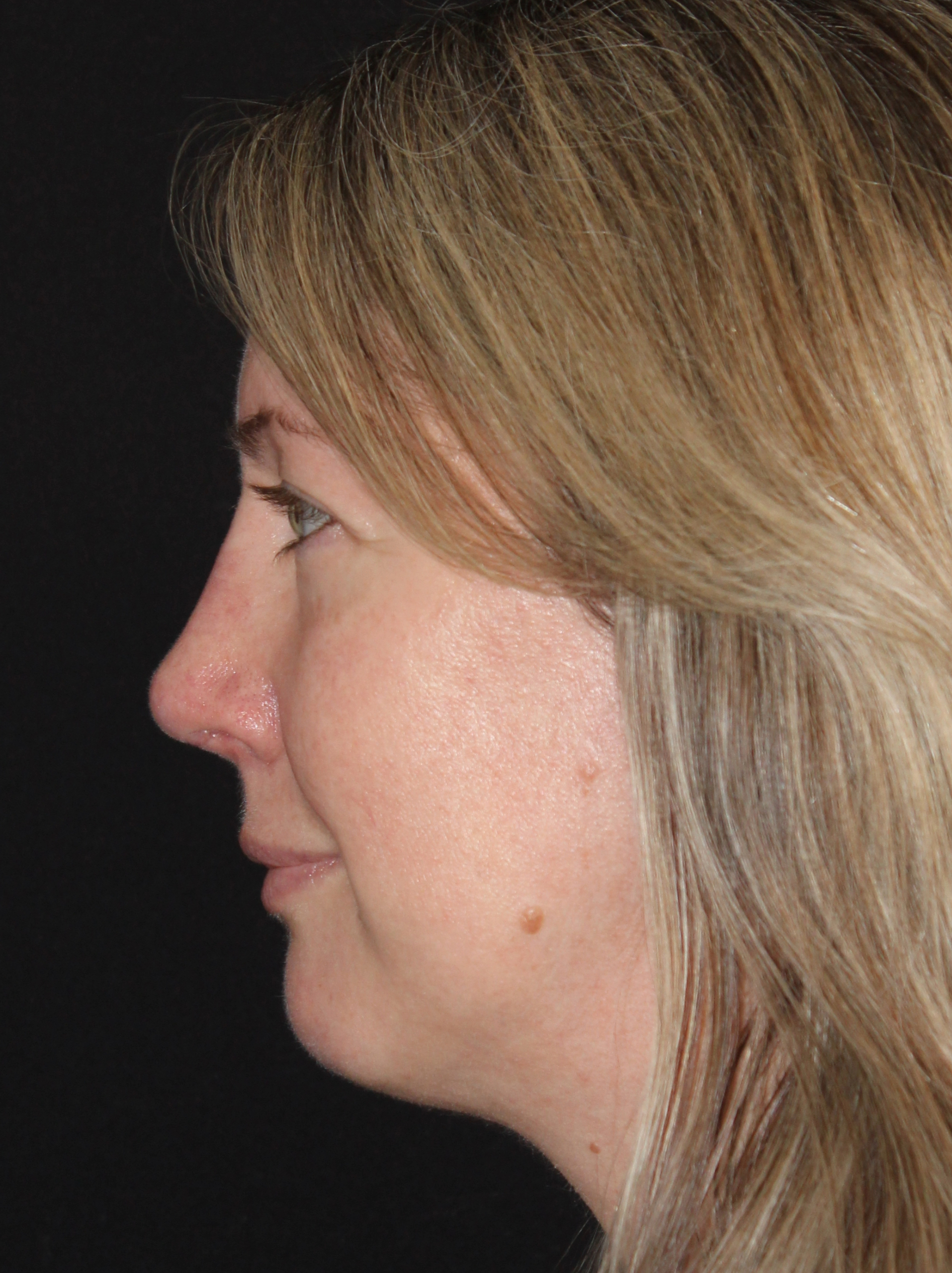 Patient 105 After Image