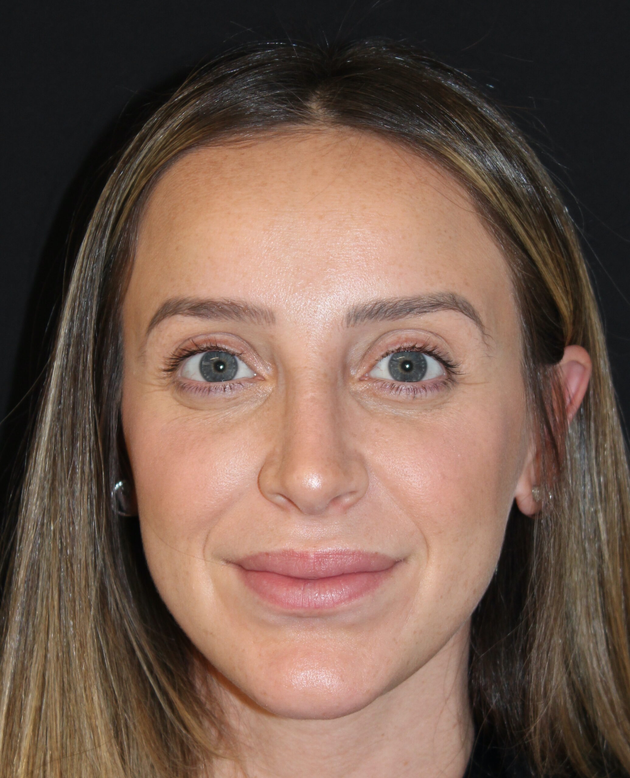 Patient #110 After Image